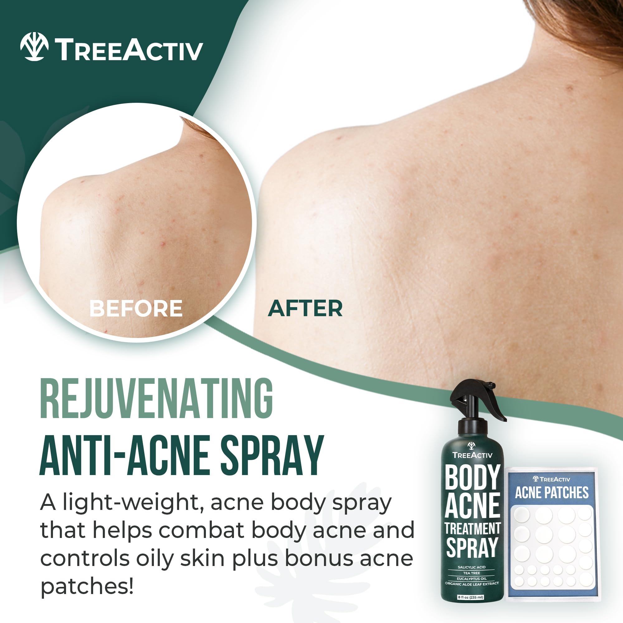 Treeactiv Body Acne Treatment Spray, 8 Fl Oz, 2% Salicylic Acid Spray For Body, Back Acne Treatment Spray With Tea Tree Oil And