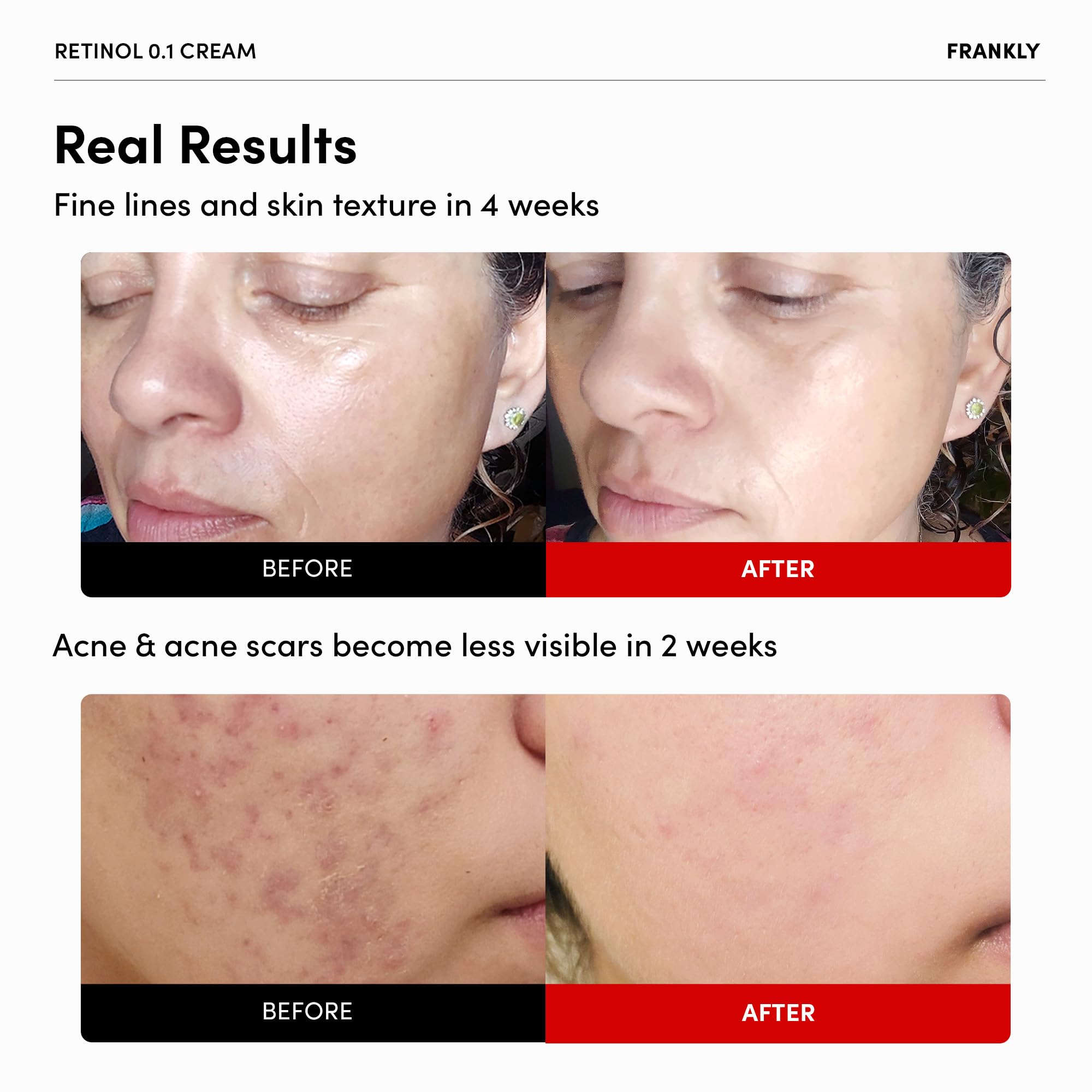 Frankly Retinol 0.1 Cream - Beginner Retinol | Fine Lines & Wrinkles Care, Acne Care, Skin Lifting & Restoration, Anti-Aging | C