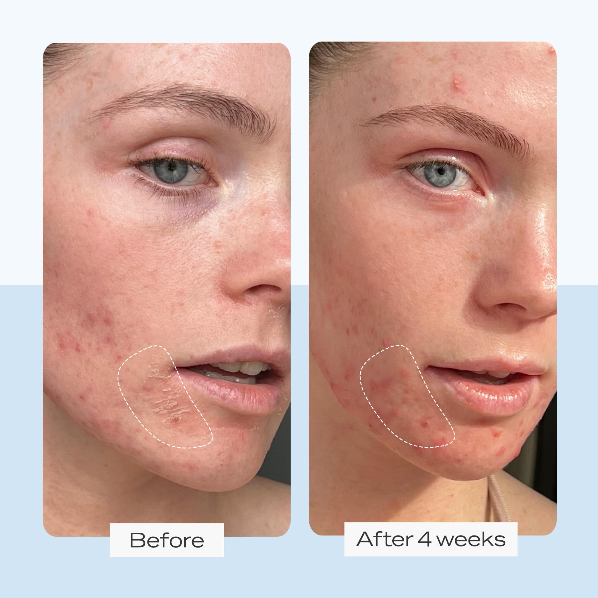 First Aid Beauty Ultra Repair Cream - Intense Hydration, 12 oz, Clinically Proven for Eczema Relief, Luxury Face & Body Moisturizer
