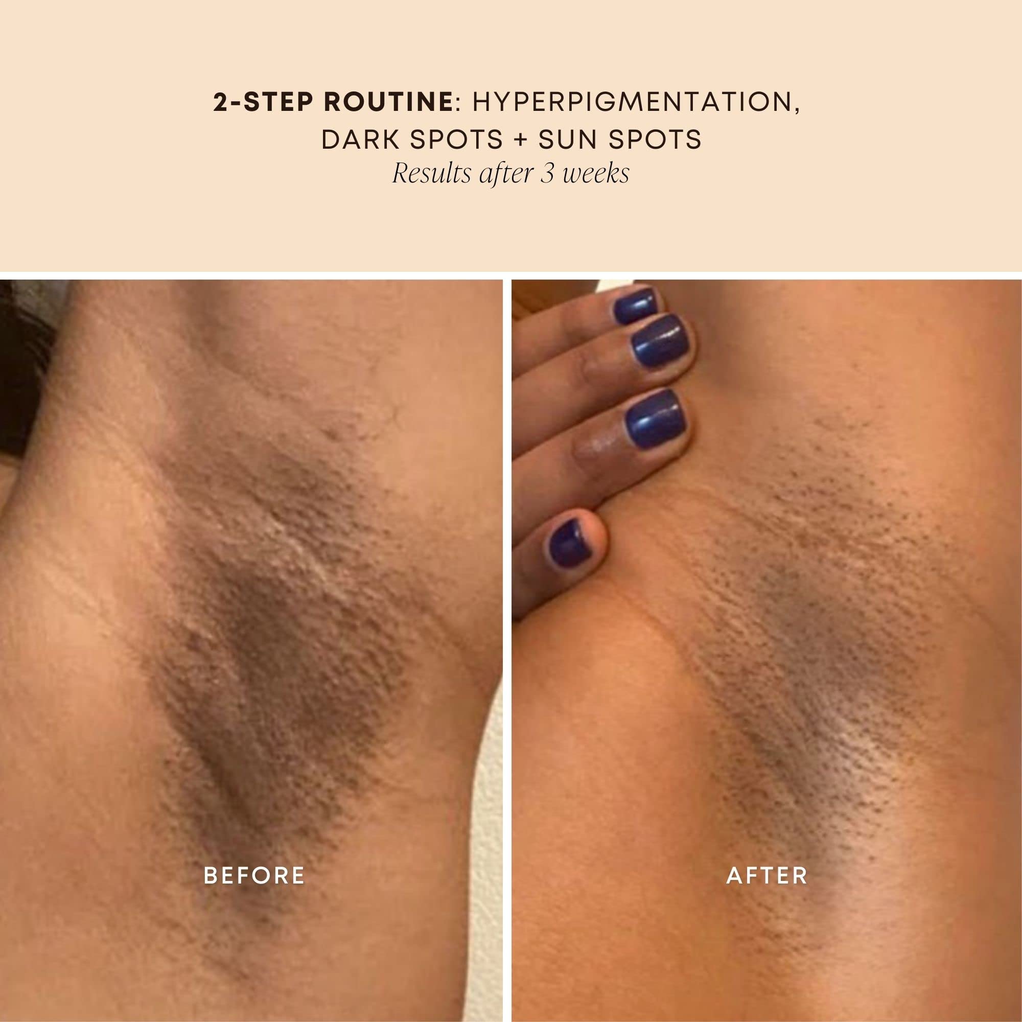 Bushbalm Dark Spot Oil - Improve Appearance Of Dark Spots, Ingrown Hair All Over Body, Soothe, Rejuvenate And Nourish, Bermuda O