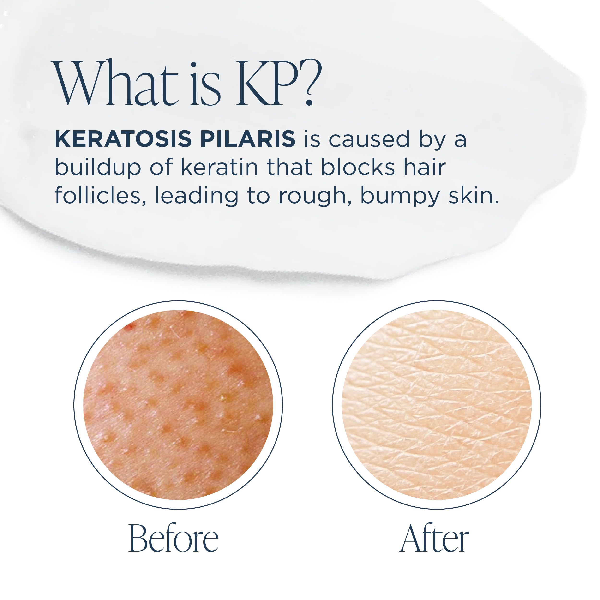 Glytone KP Kit - Exfoliating Body Wash, Glycolic Acid Lotion & Shower Pouf for Keratosis Pilaris - Smooth Rough Bumpy Skin, Frag