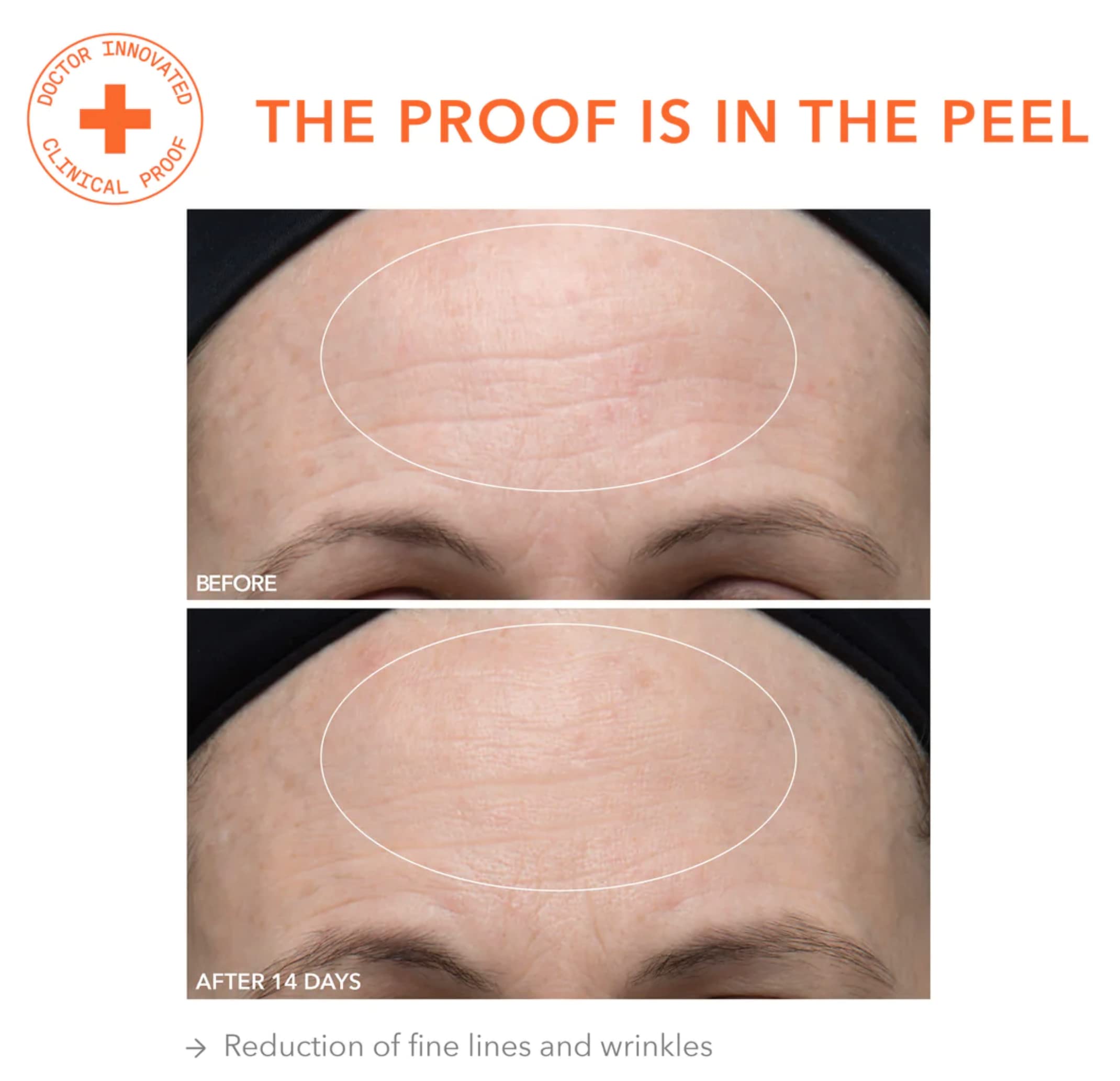Dr. Dennis Gross Alpha Beta Ultra Gentle Daily Peel: For Dehydrated Or Sensitive Skin, Uneven Tone Or Texture, Fine Lines Or Enl