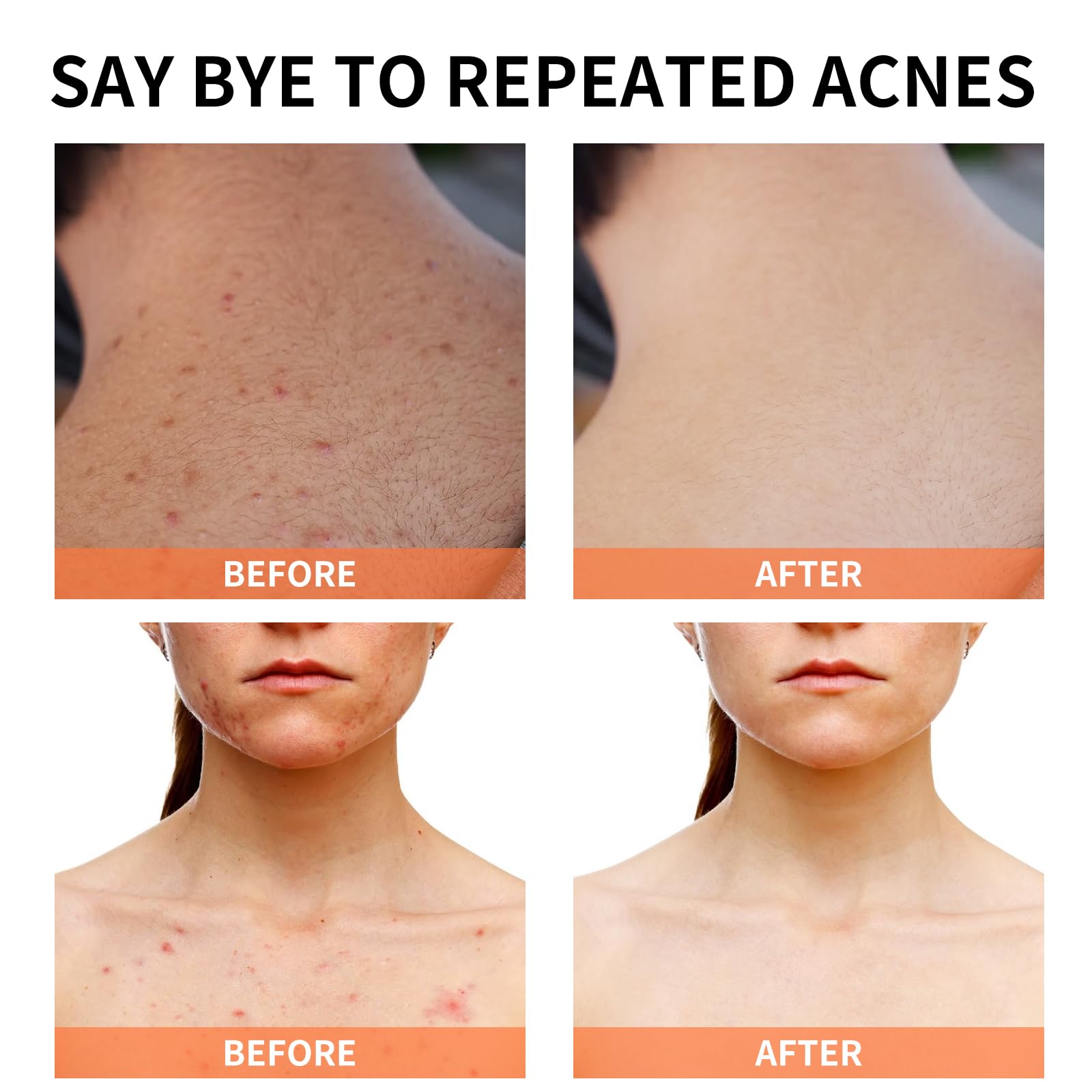 Acne Treatment for Face for Hormonal Cystic Stubborn Acne Cream for Sensitive Skin Teens Adults Women Men Spot Pimple Butt Contr