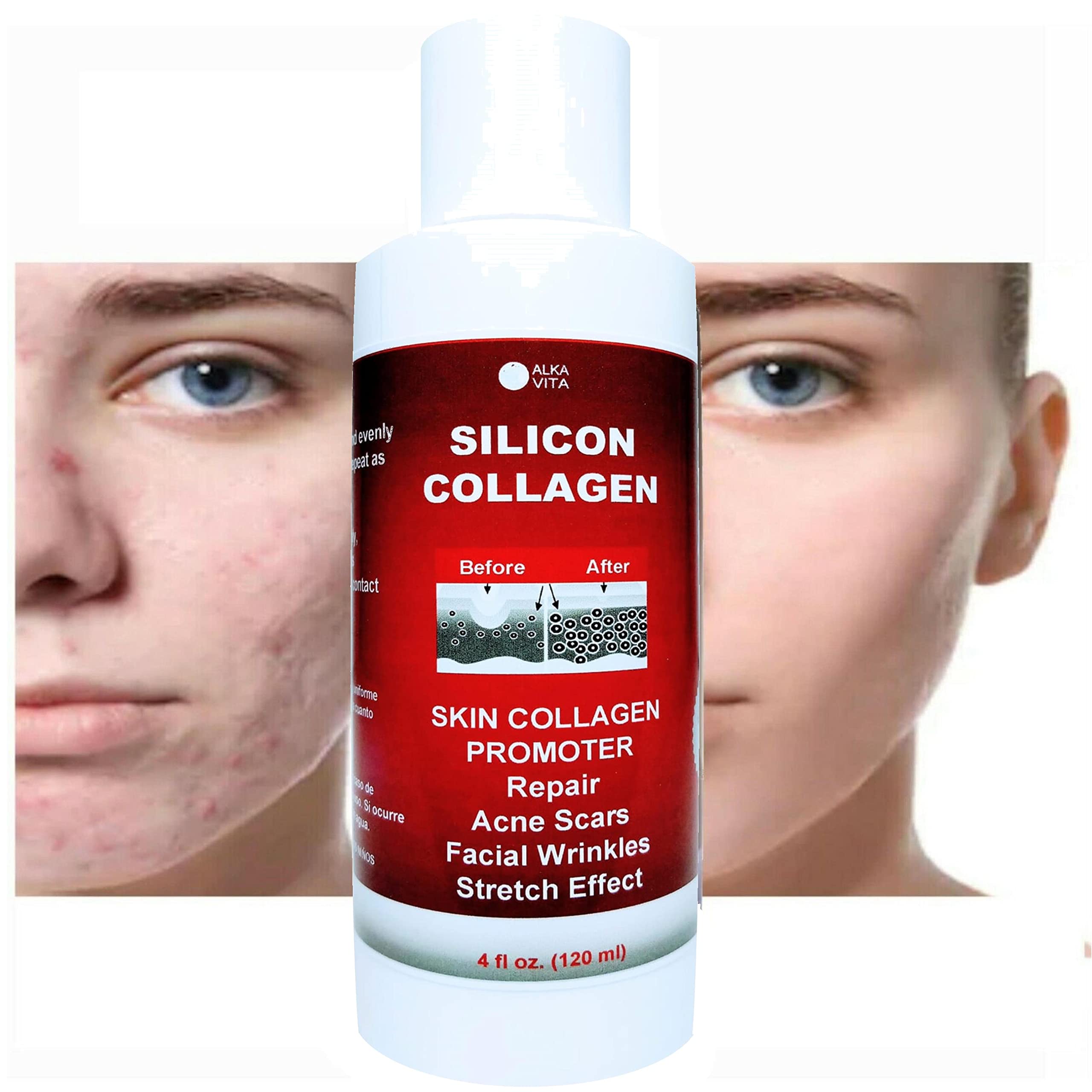 Skin Scars Silicon and Collagen Hydrolyzed Gel Resurfacing Skin Collagen Promoter For Indented Atrophic Rolling Face Scars By AL
