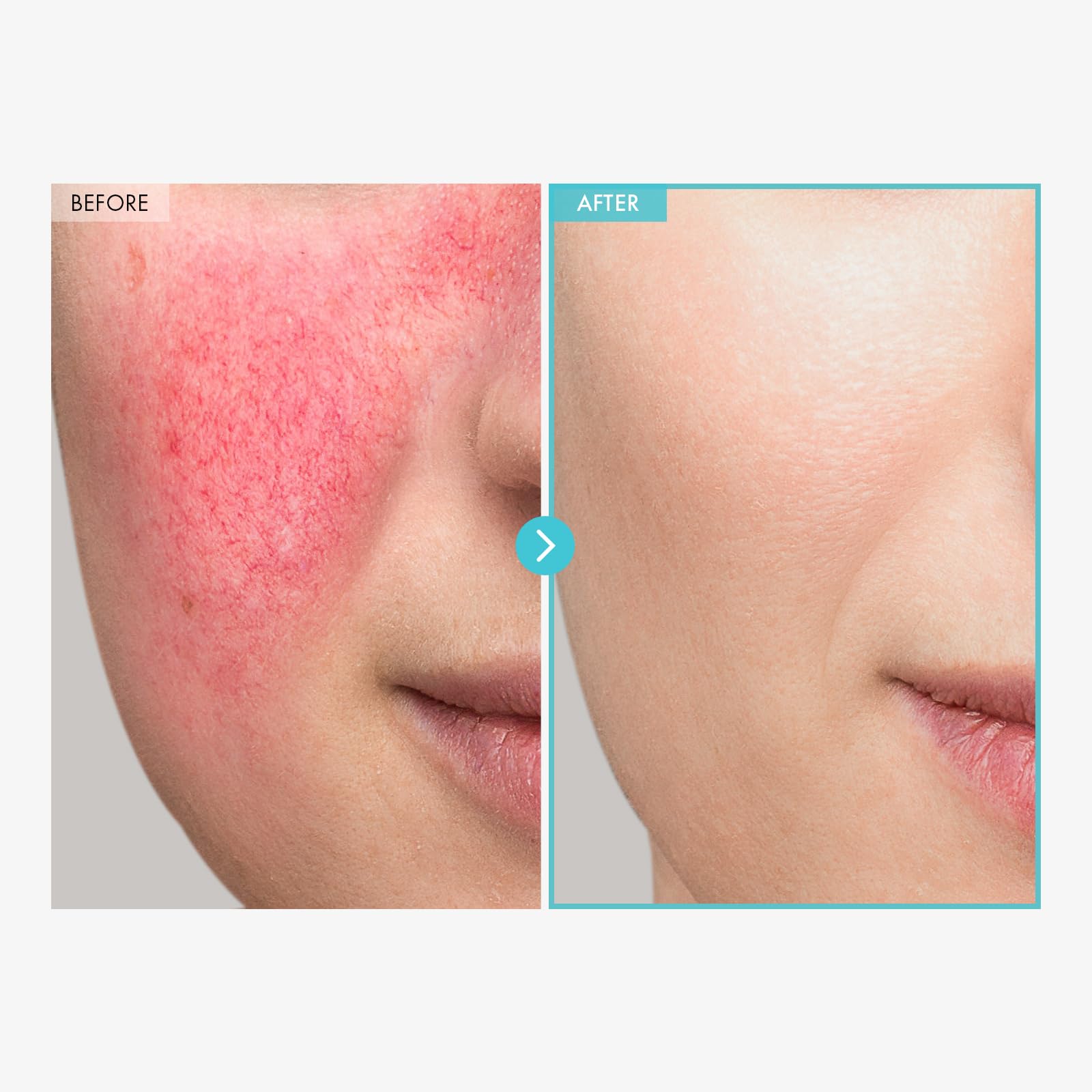 Tosowoong Sos Repair Cica Clinic Zinc Cream, 100,000Ppm Zinc Oxide, Heal And Soothe Acne, Skin Barrier Repair, Moisture Barrier