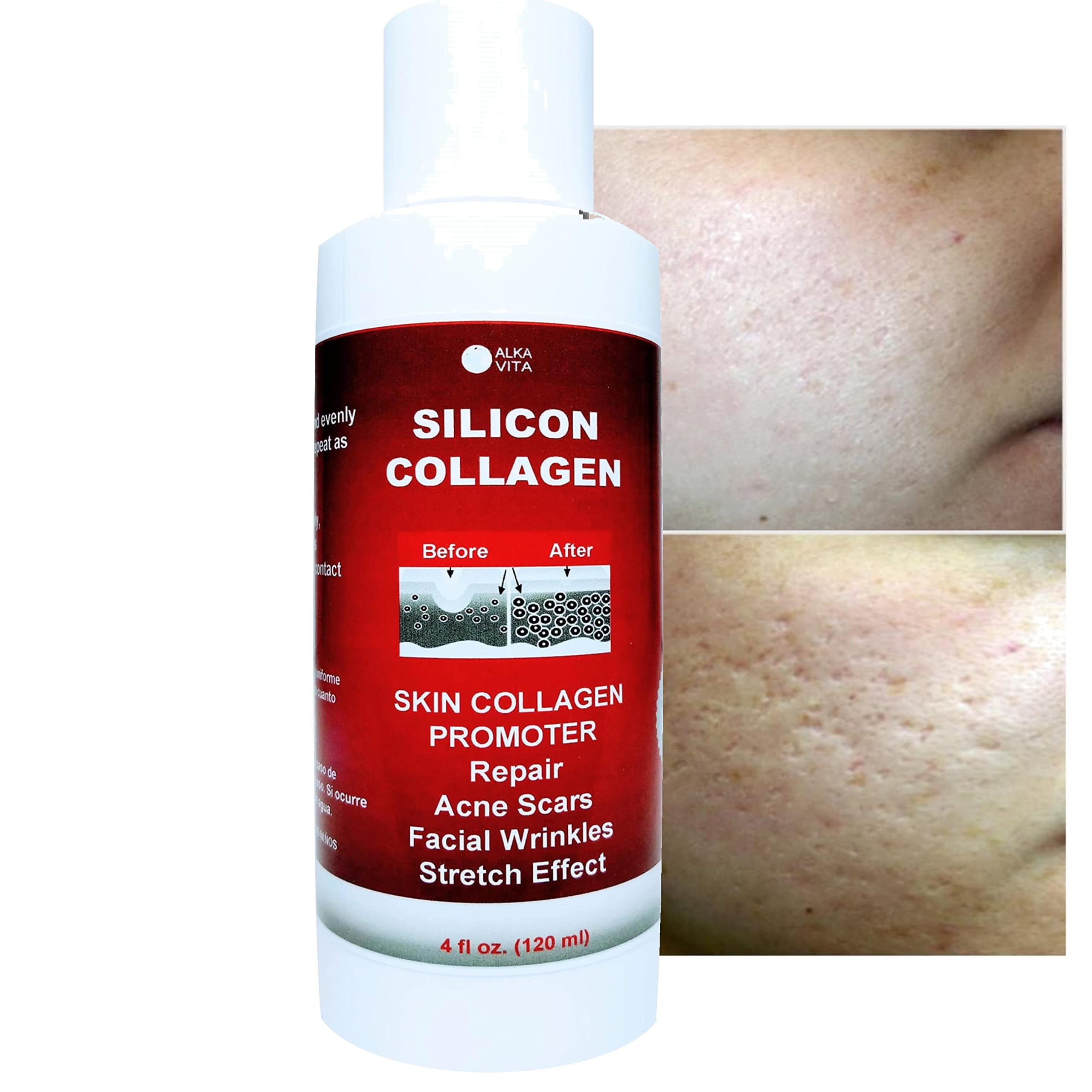 Skin Scars Silicon And Collagen Hydrolyzed Gel Resurfacing Skin Collagen Promoter For Indented Atrophic Rolling Face Scars By Al