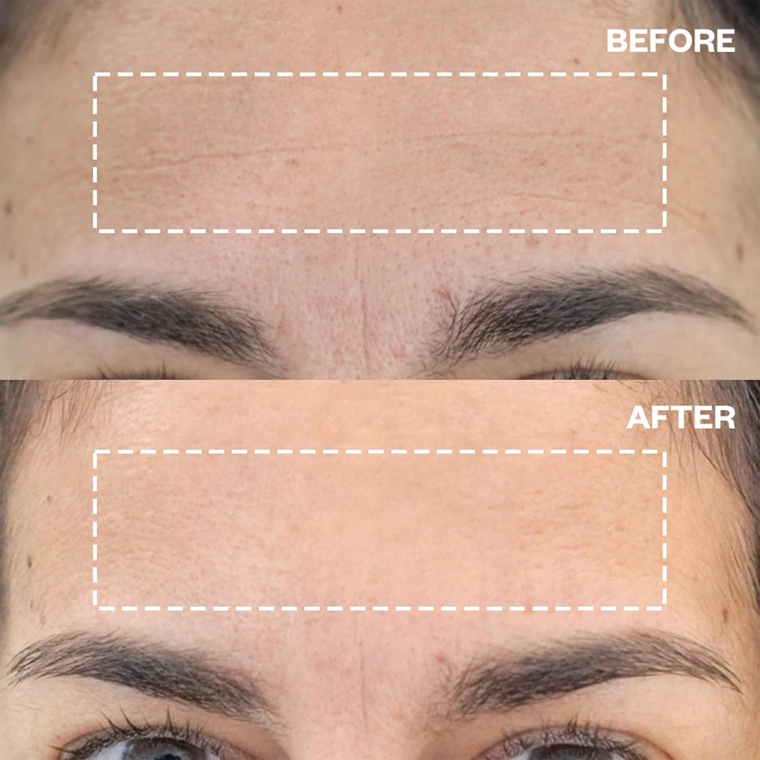 Wrinkles Schminkles Forehead Wrinkle Patches, 4-Pack, Reusable Hypoallergenic Silicone Smoothing Pads for Reducing Frown Lines &