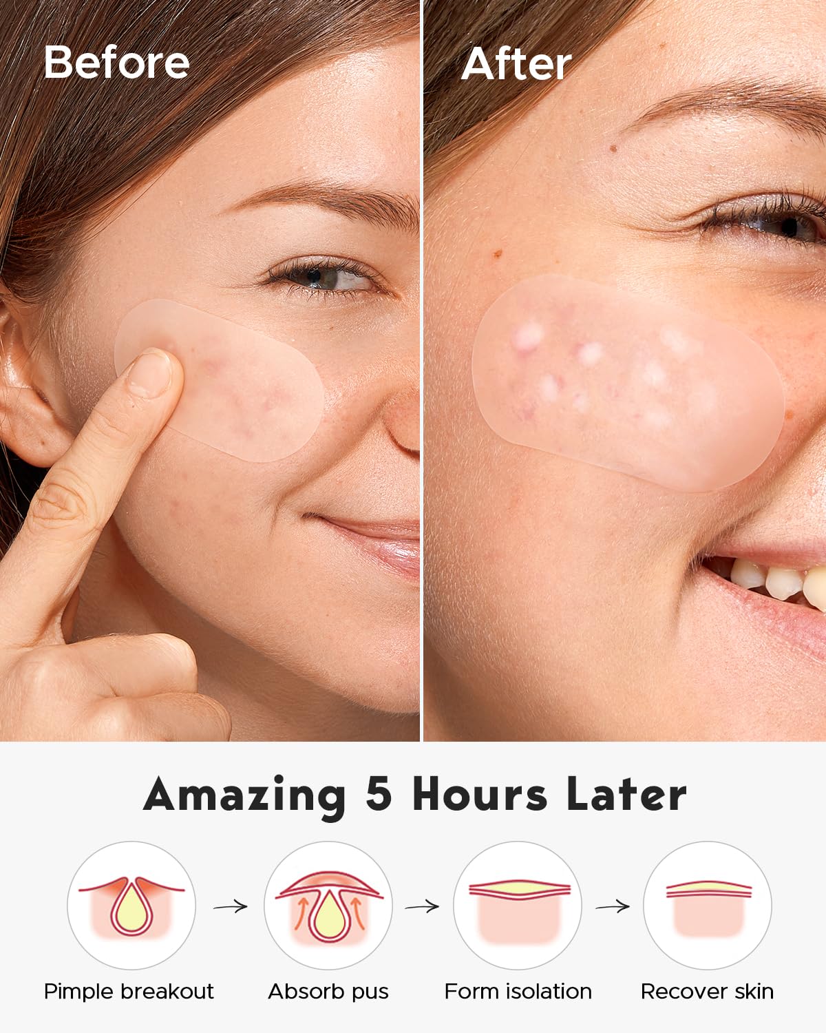 LitBear Large Pimple Patches - 80 Pieces, Reduces Inflammation, with Tea Tree & Calendula Oil, Transparent