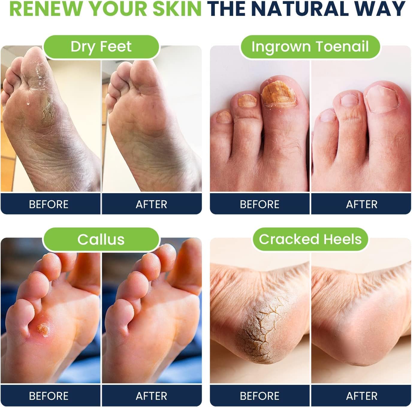Tea Tree Oil & Soothing Lavender Foot Soak With Epsom Salt - Best Toenail Treatment & Softens Calluses - Soothes Sore & Tired Fe