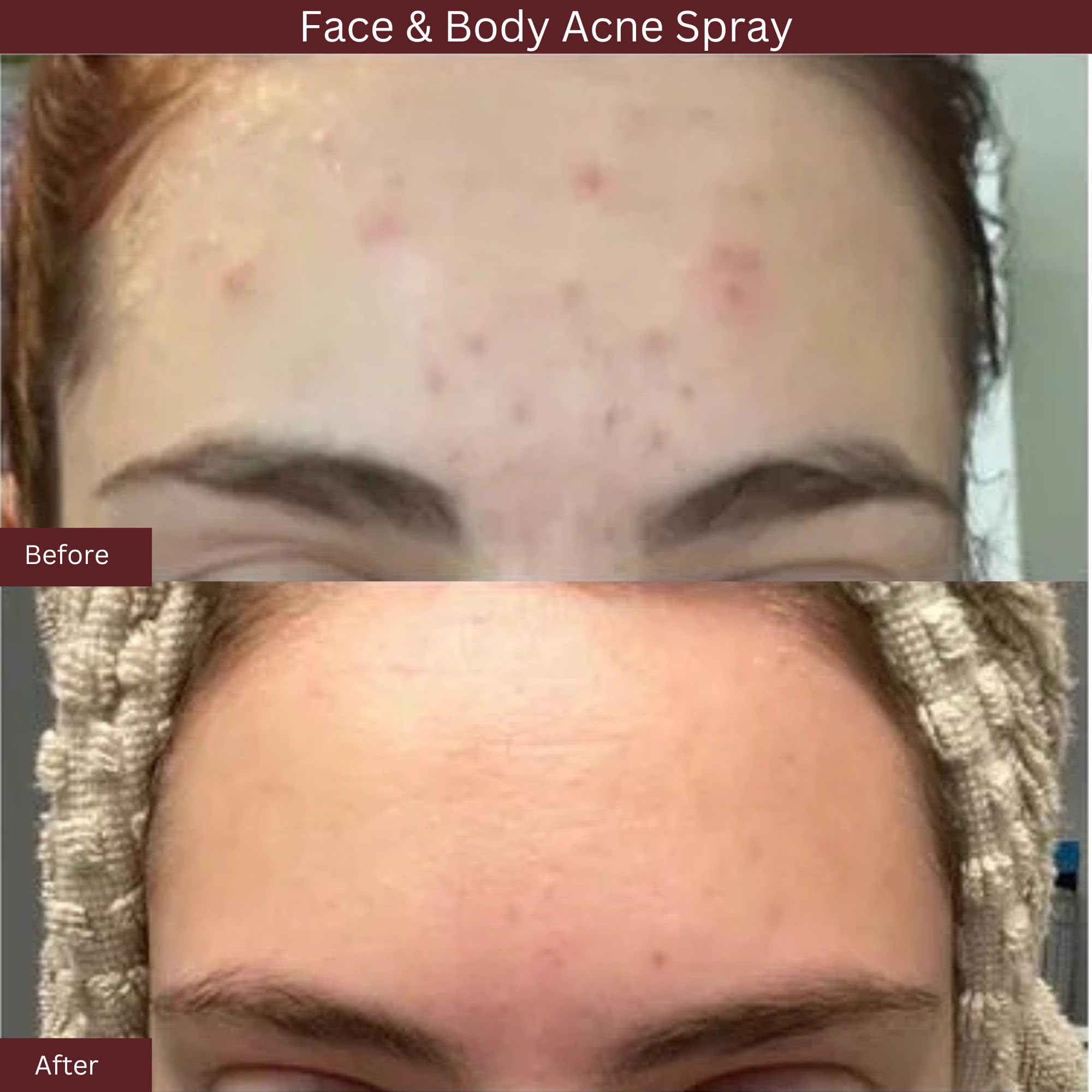 ITK Skincare 2% Salicylic Acid Spray - Acne Treatment for Face & Body, 3.3oz, Clear Blemish Mist for Post Workout