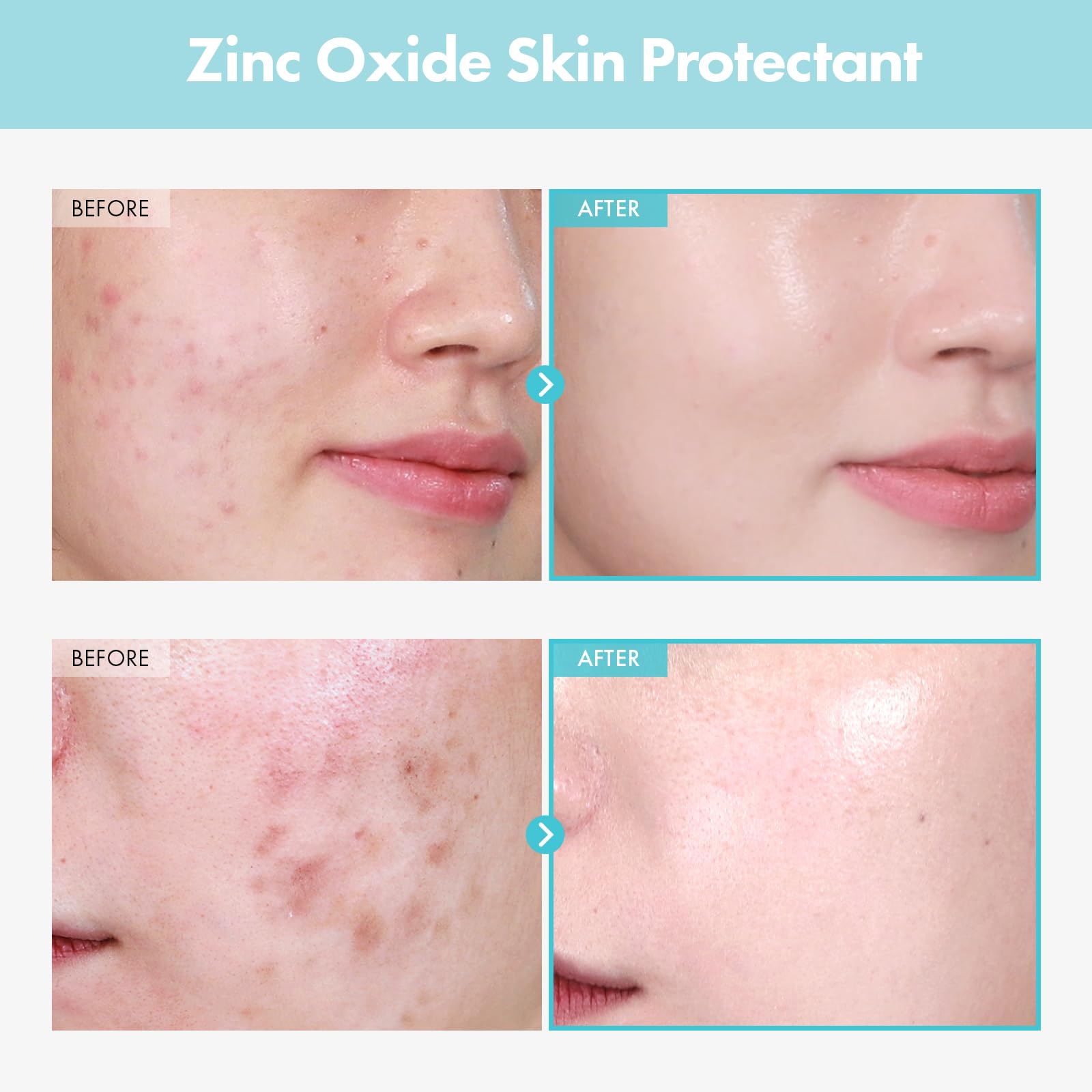 Tosowoong Sos Repair Cica Clinic Zinc Cream, 100,000Ppm Zinc Oxide, Heal And Soothe Acne, Skin Barrier Repair, Moisture Barrier
