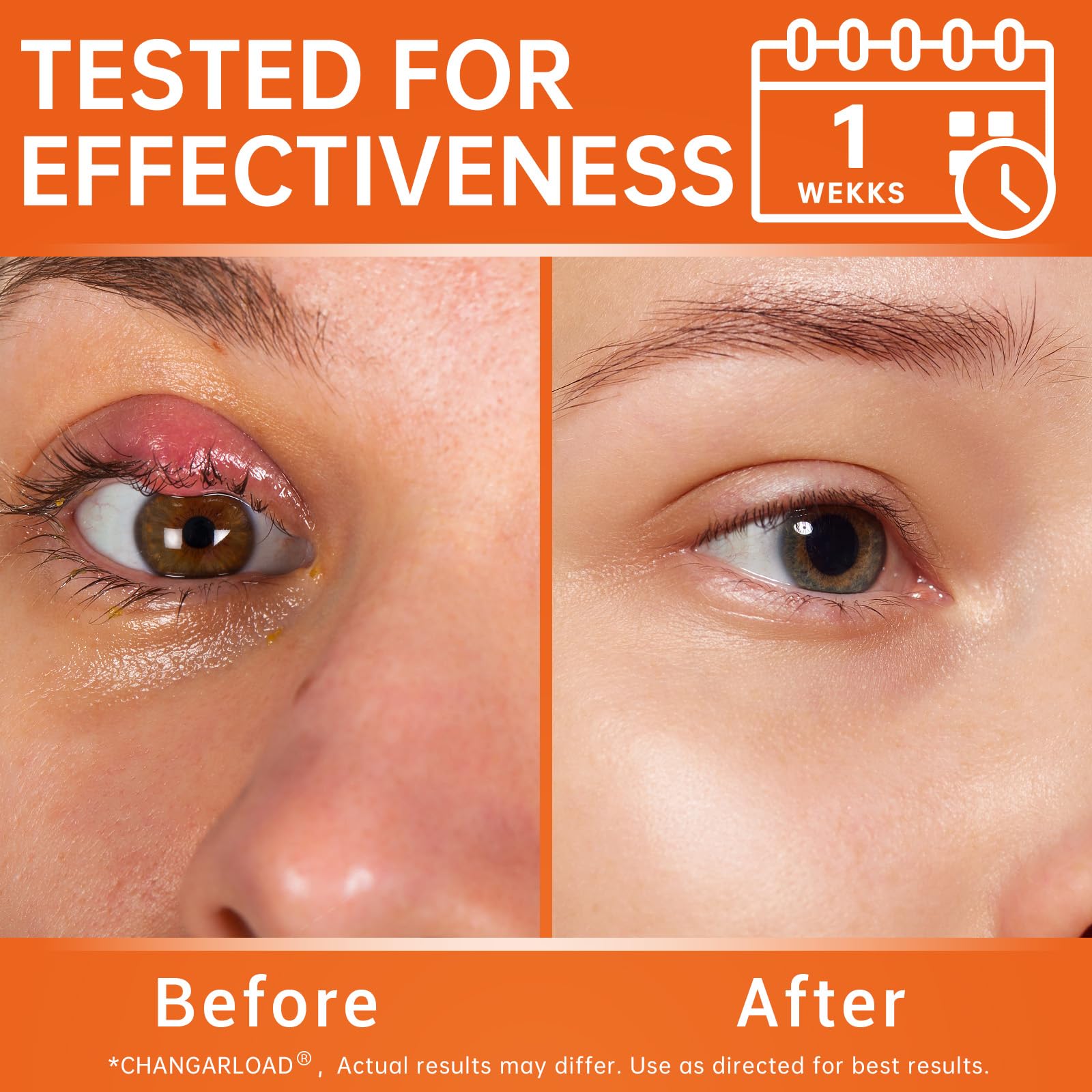 Stye Eye Relief Gel with Tea Tree Oil,Calendula & Vitamin E-Gentle Soothing Serum for Styes,Chalazion & Blepharitis,Soothing Eye