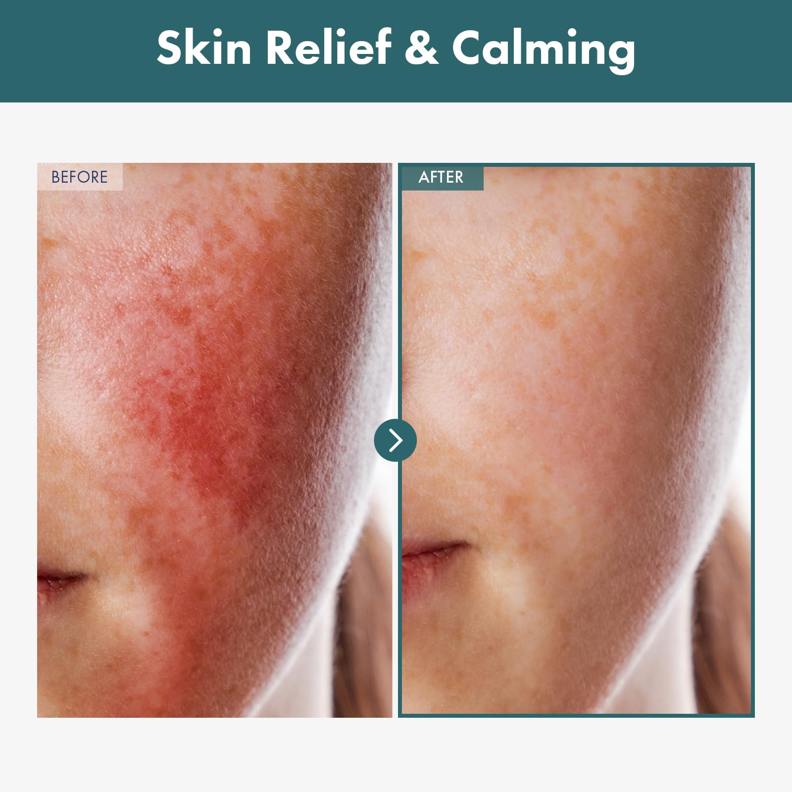 TOSOWOONG Adenosine Cica Cream, 520,000ppm Centella Asiatica, Redness Reducing for Oily and Dry Skin Moisturizer, Barrier Cream