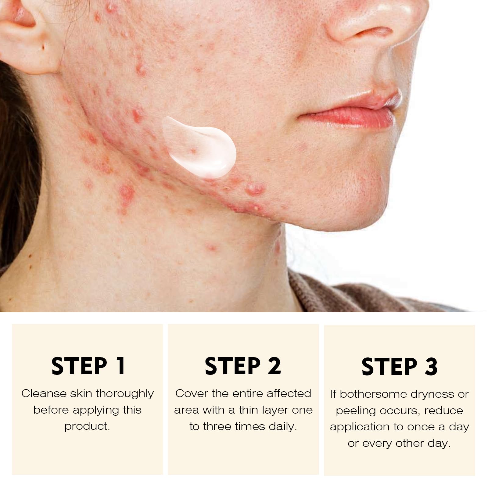 Acne Treatment for Face for Hormonal Cystic Stubborn Acne Cream for Sensitive Skin Teens Adults Women Men Spot Pimple Butt Contr