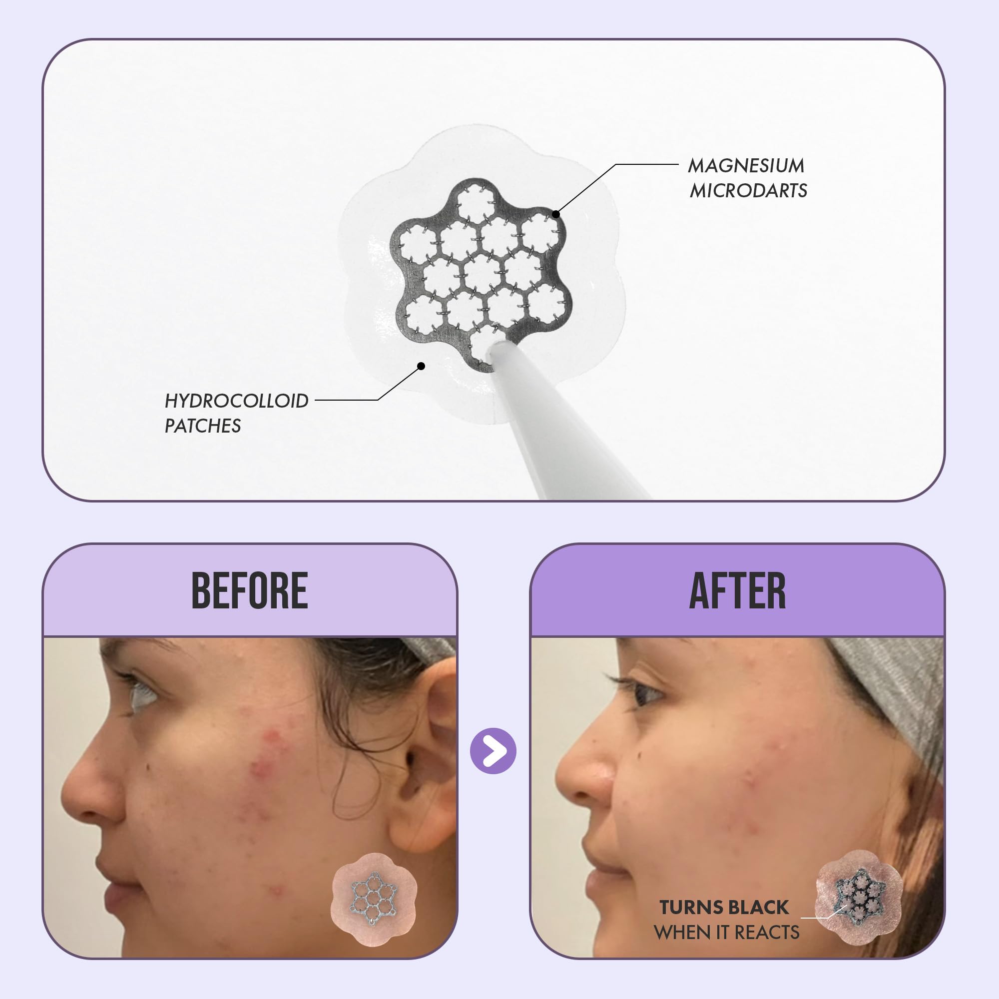 Deep Blemish Microdarts | Pimple Patch | Cystic Acne | Fast-Acting | Quick Calming | 99.9% Pure Magnesium | Madecassic Acid | Te