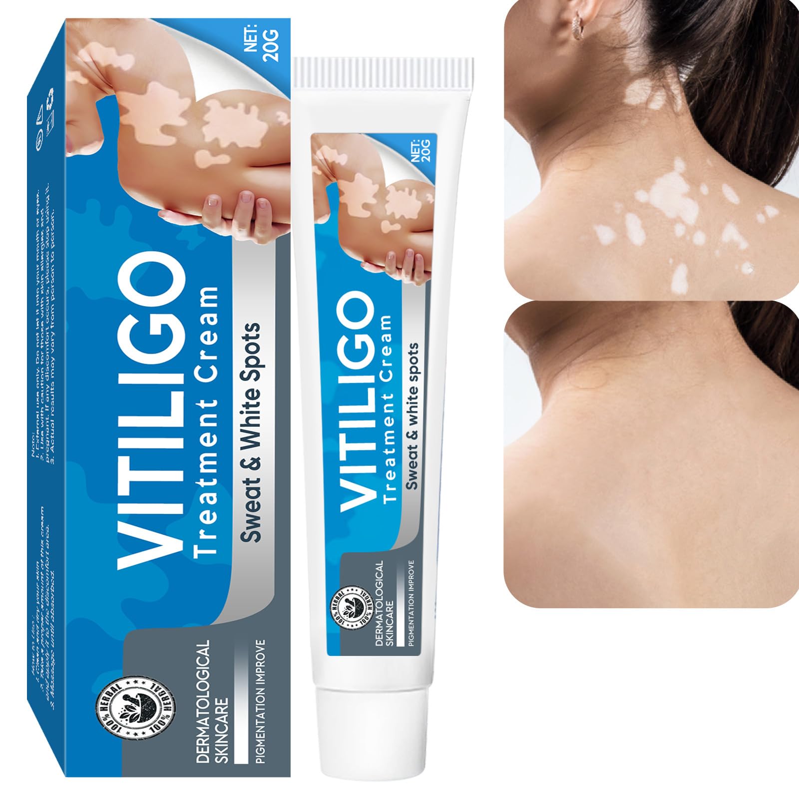 Vitiligo Cream, Natural Vitiligo Treatment for Skin Vitiligo, Reduce White Spots and Improve Skin Pigmentation, Easy to Use, Vit