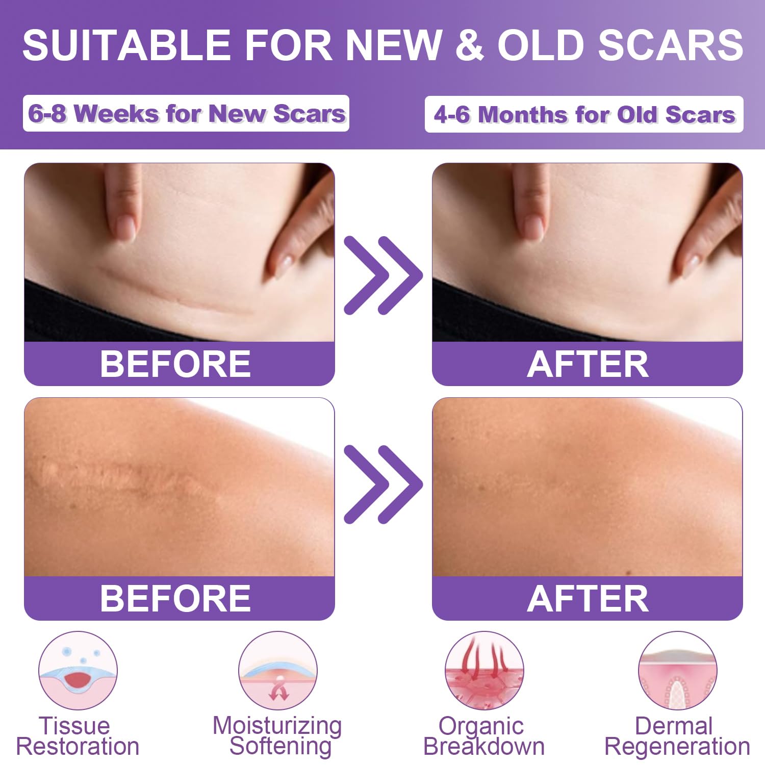 Mitgary Silicone Scar Sheets, Medical Grade, 1.6" x 120", Brown, Reusable for Keloids, Surgery Scars, C-sections, Burns