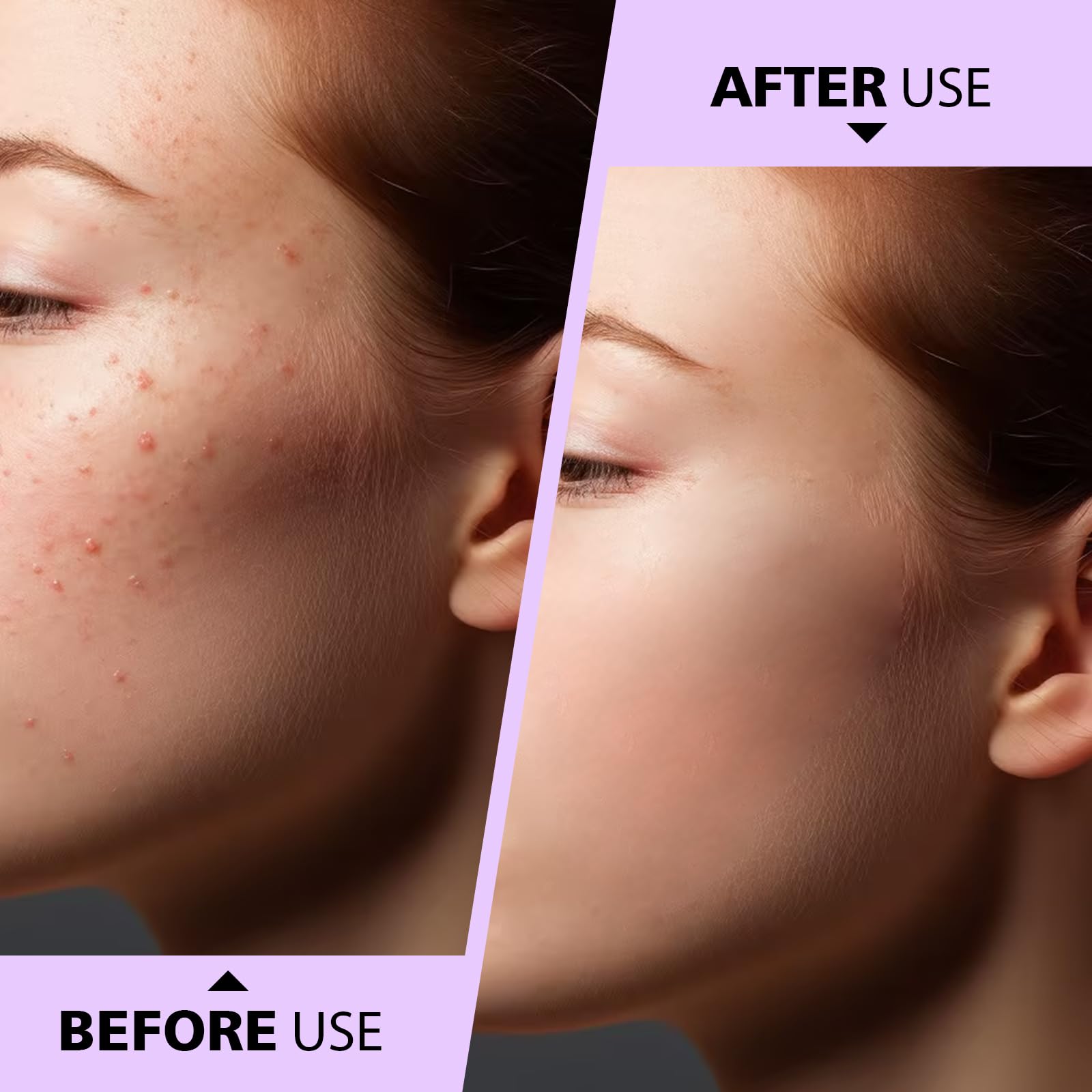 Teenitor Pimple Extractor Acne Treatment Surgical Grade Blackhead Comedone Removal 2-In-1 Popper Tool For Face Nose