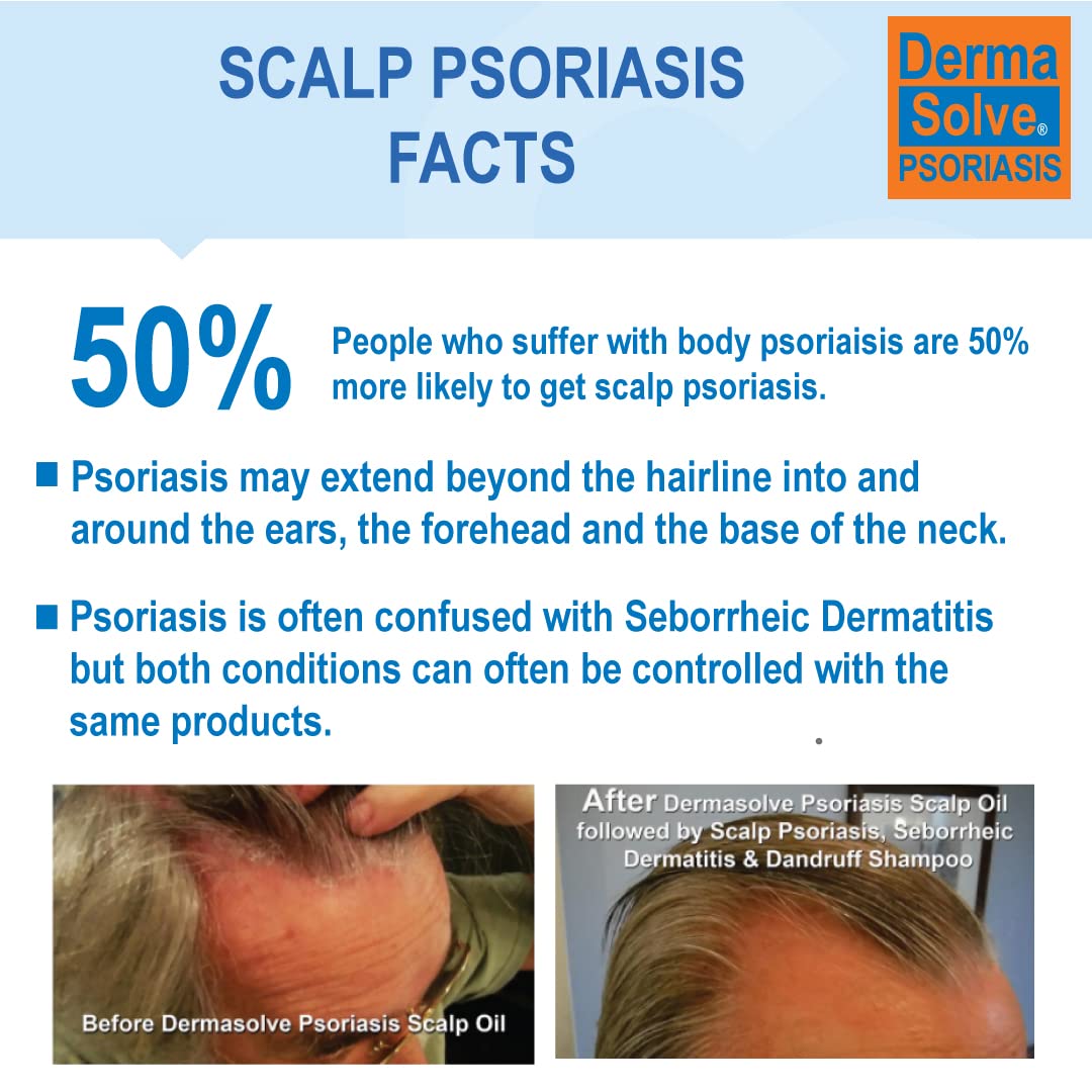 Dermasolve Psoriasis & Dandruff Shampoo + Conditioner, 8 oz - Heals Itchy, Flaky Skin, Soothes & Moisturizes Inflamed Scalp