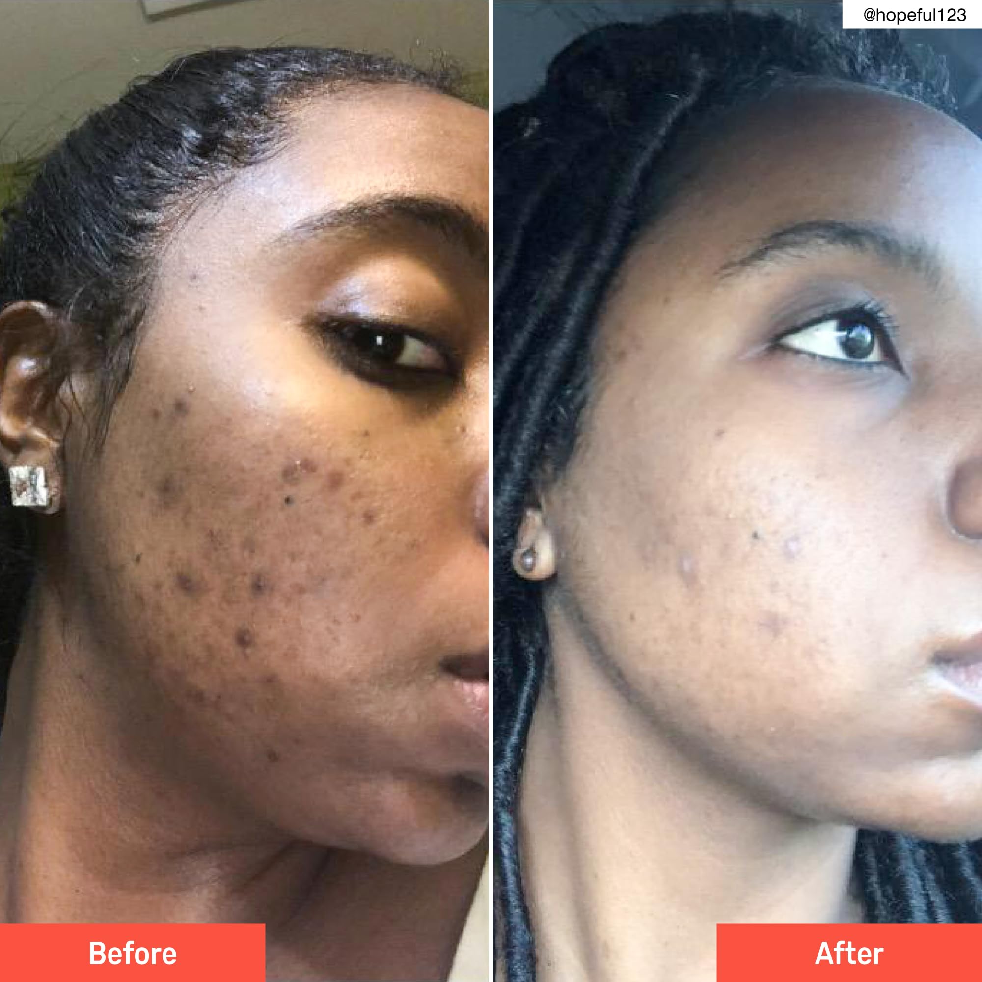 Pure Kojic Acid Skin Brightening Soap For Reduce Dark Spots & Glowing Skin, Moisturizing For Face & Body, Reduce Acne Scars, Mel