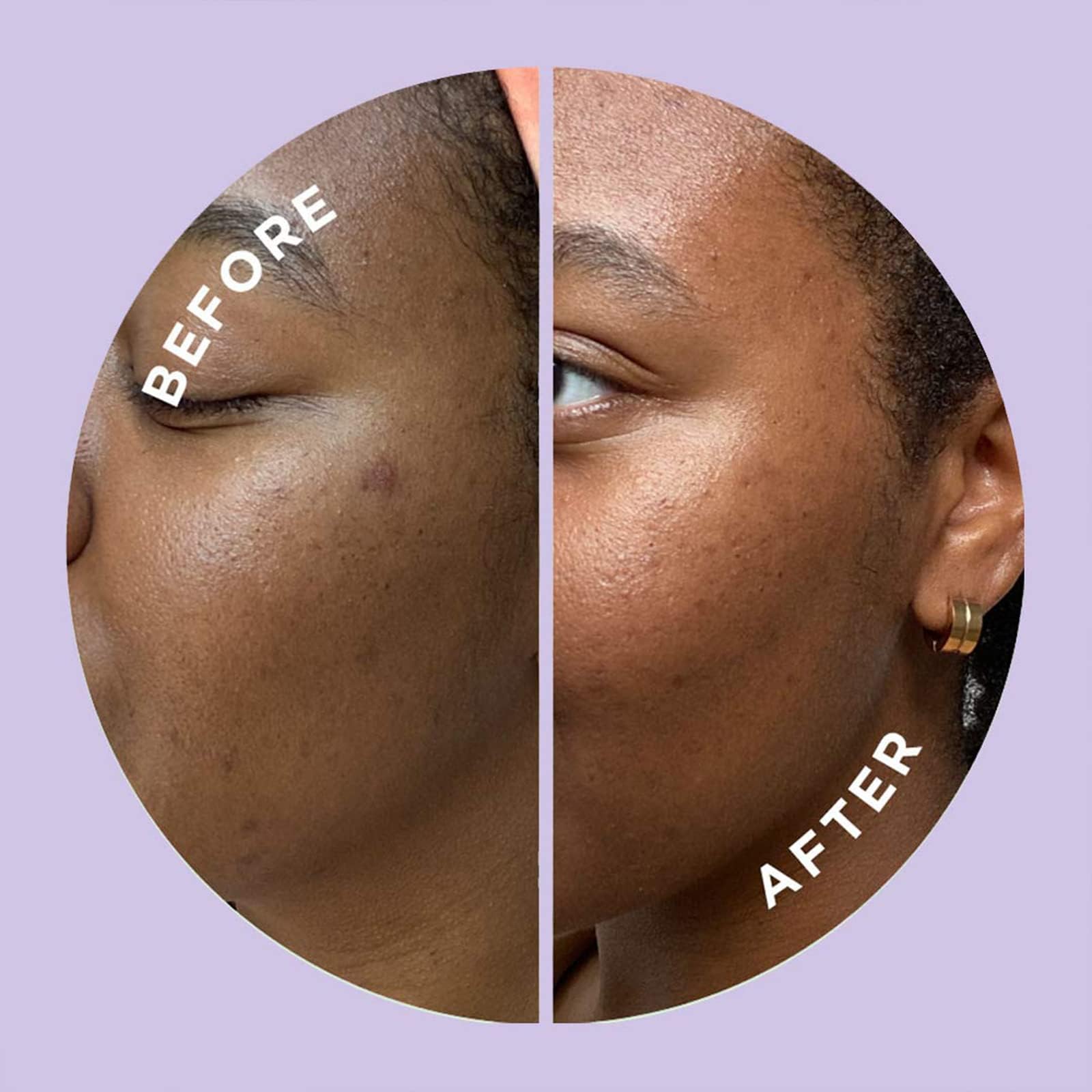 Zitsticka Hyperfade Acne Patches For Face - World'S Most Potent Pimple Patch With Fast-Acting Microdarts - Starts Working Within