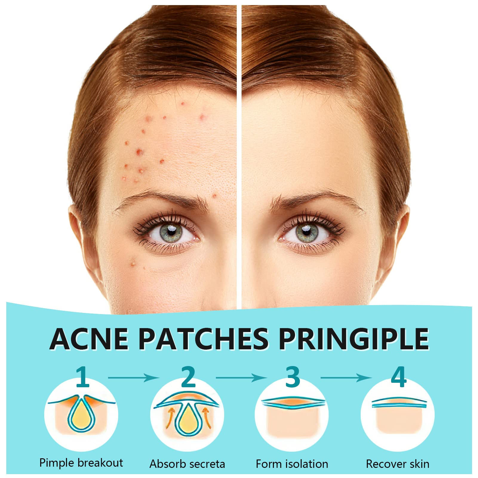 Pimple Patches for Face 180 Counts Hydrocolloid Acne Patches for face Invisible Zit Patches Acne Spot Treatment/Blemish Patches