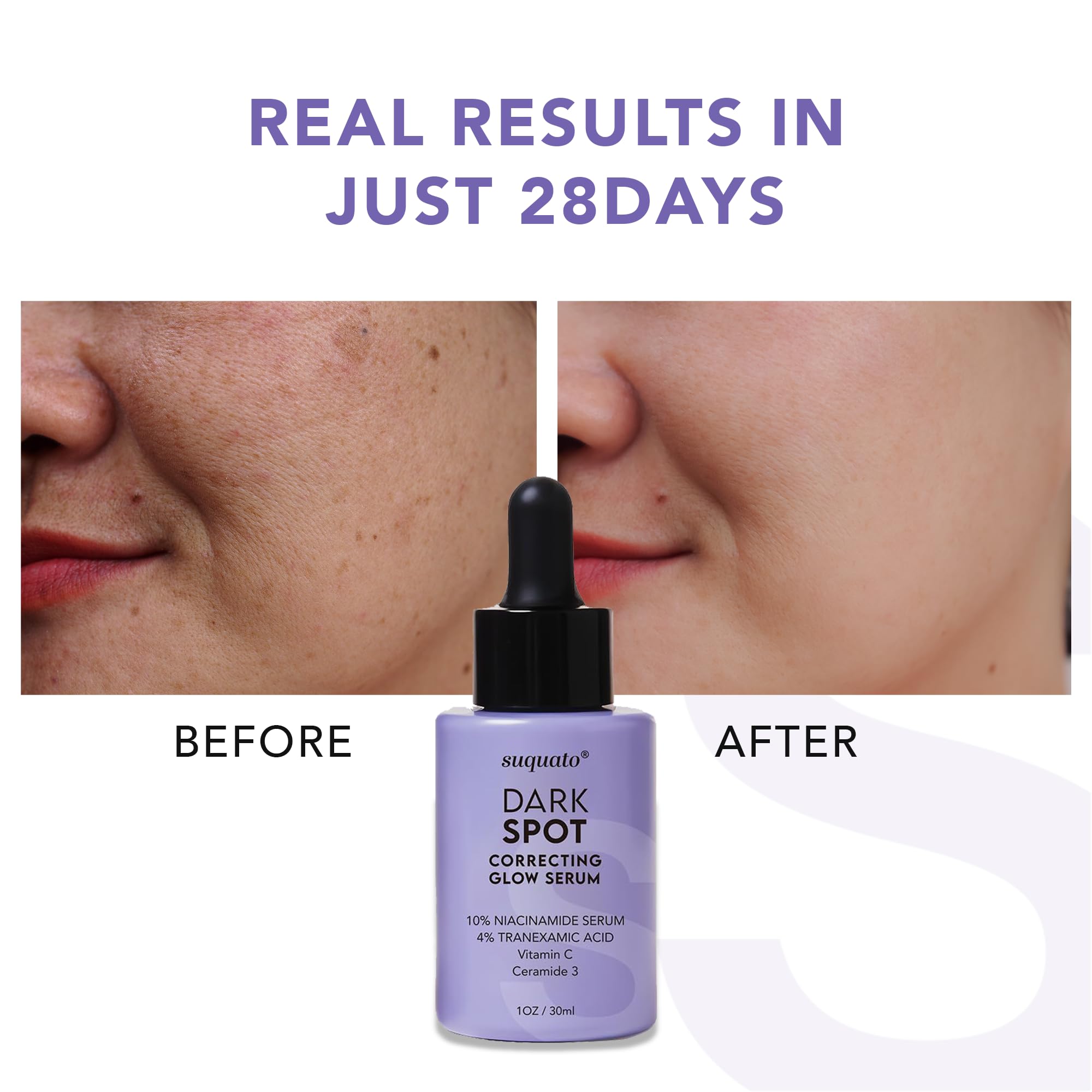 Dark Spot Correcting Glow Serum: Melasma Hyperpigmentation Treatment for Face with Tranexamic Acid Niacinamide - Vitamin C Serum