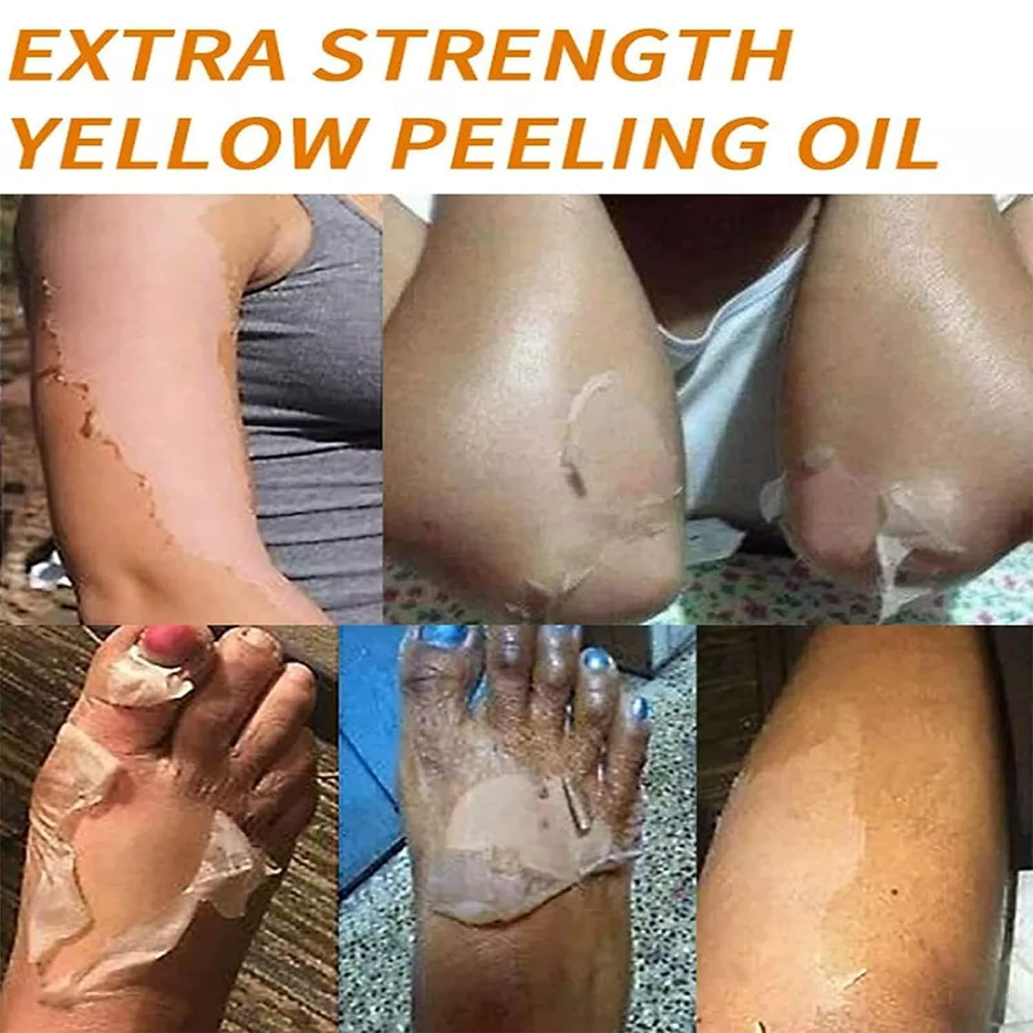 Generic Peeling Oil, Extra Strong Peeling Oil, Yellow Peeling Oil For Dark Skin, Exfoliating Peeling Solution For Body, Hand, Fe