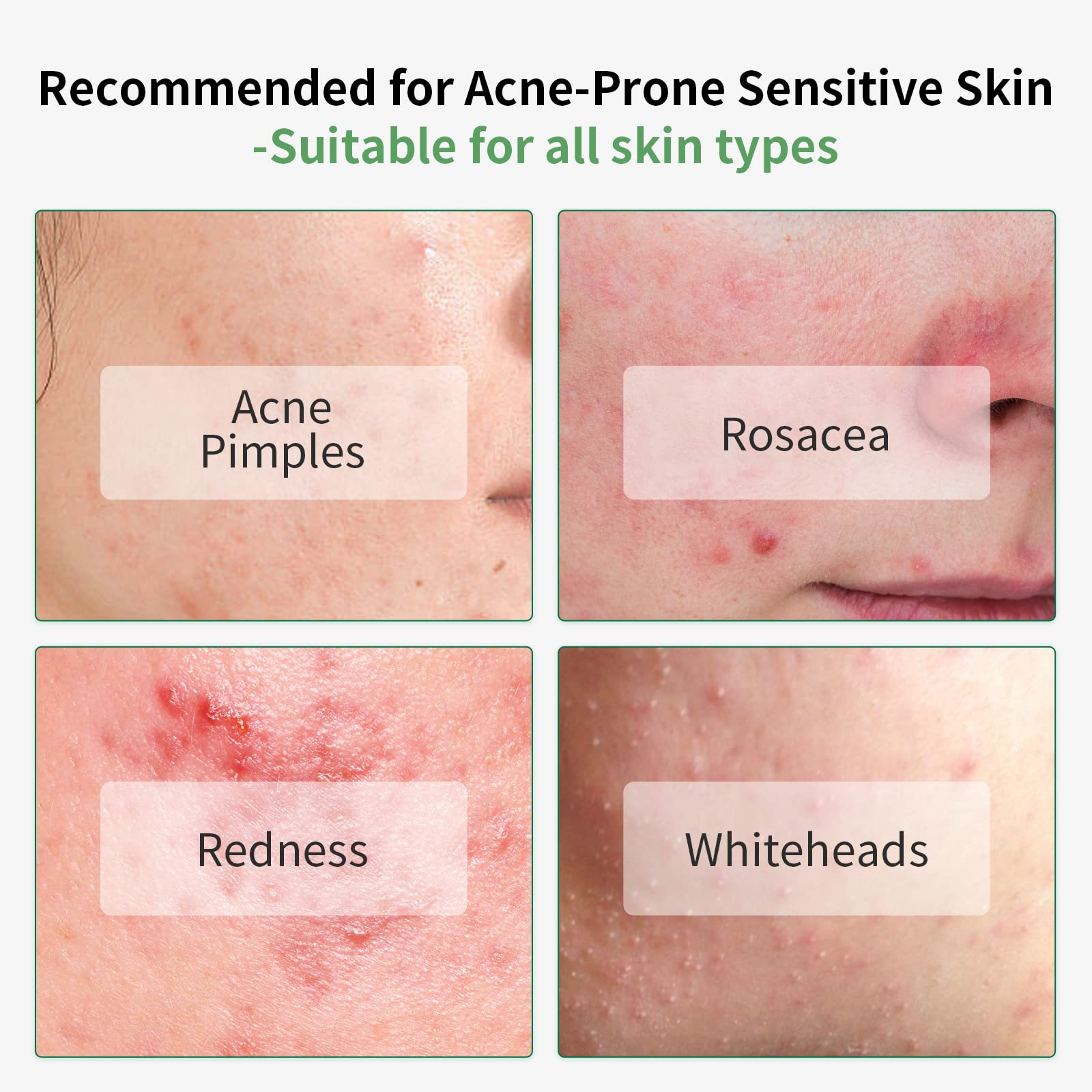 Acne Treatment Face Serum, 10% Salicylic Acid, Pimples Remover & Dead Skin Peels, Relieve Redness Rosacea Blemish, Centella Asia