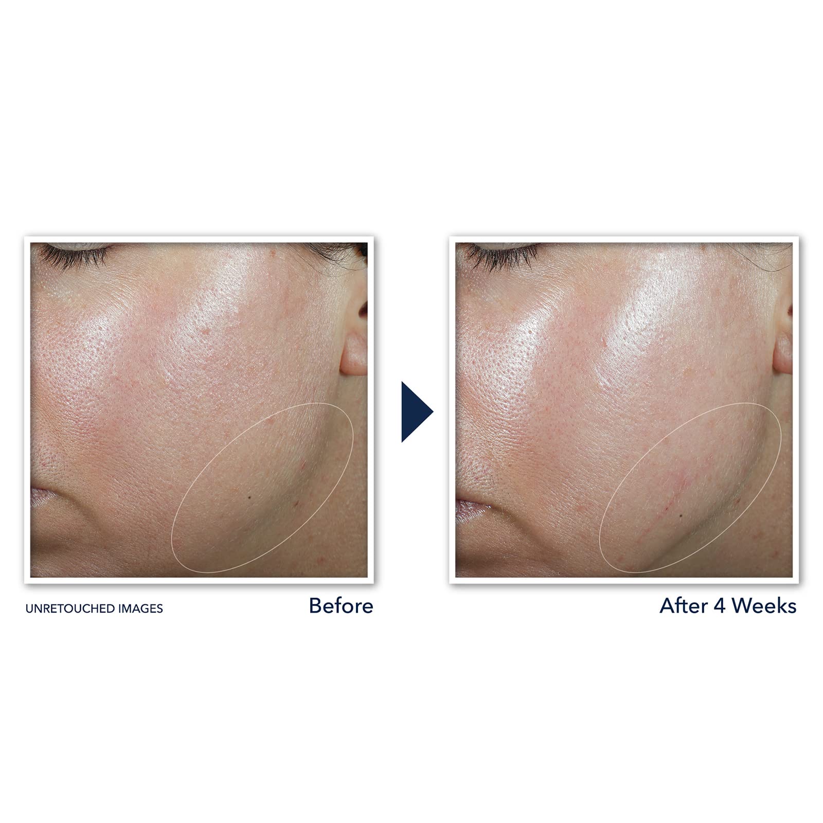 Roc Derm Correxion Neck Cream With Hyaluronic Acid And Advanced Retinol To Visibly Tighten & Lift Horizontal Neck Lines, Facial