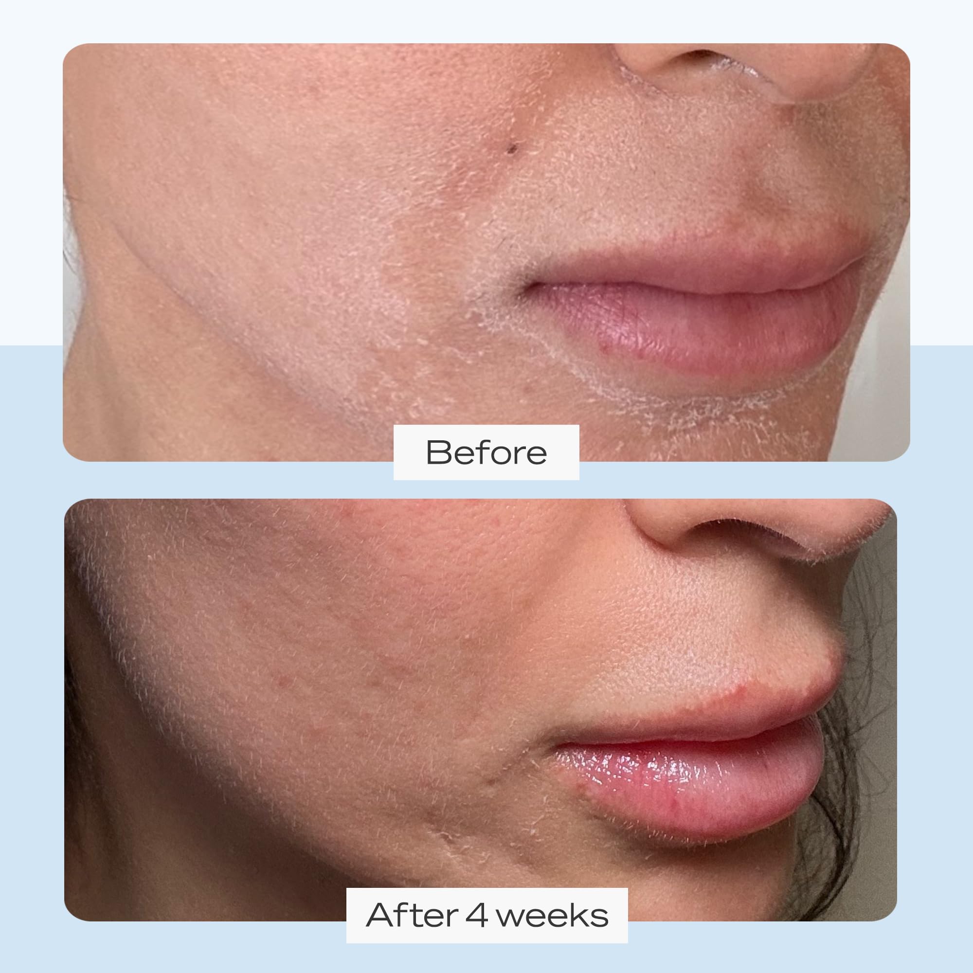 First Aid Beauty Ultra Repair Cream - Intense Hydration, 12 oz, Clinically Proven for Eczema Relief, Luxury Face & Body Moisturizer