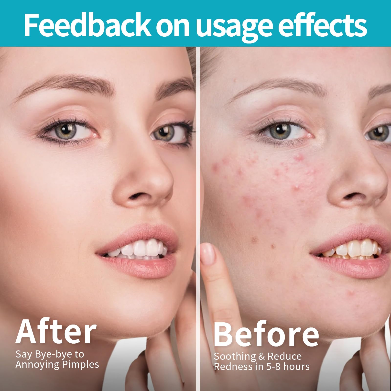 Lblmax 648 Counts Pimple Patches,Hydrocolloid Spot Dots With Salicylic Acid And Tea Tree Oil