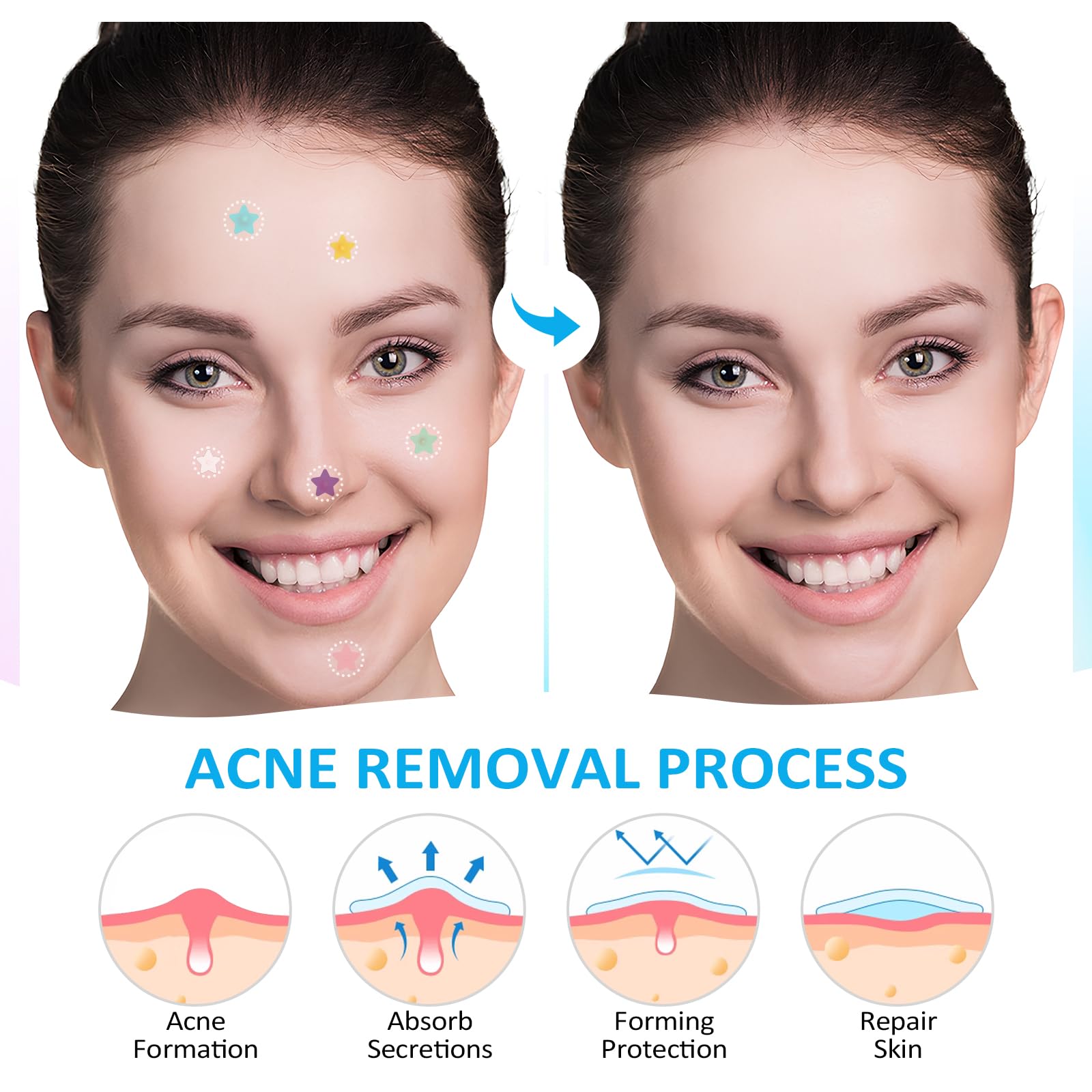 Koneuk Pimple Patches For Face 240Ct,3 Sizes Hydrocolloid Acne Patches,Cute Star Zit Patches With Tea Tree Oil,Salicylic Acid An