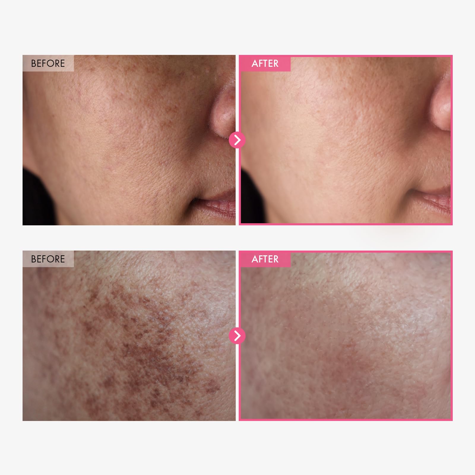 TOSOWOONG Arbutin 7% + Tranexamic Acid 4% Cream, 70,000ppm Arbutin, 40,000ppm TXA, Niacinamide, Glutathione, Dark Spots, Freckle
