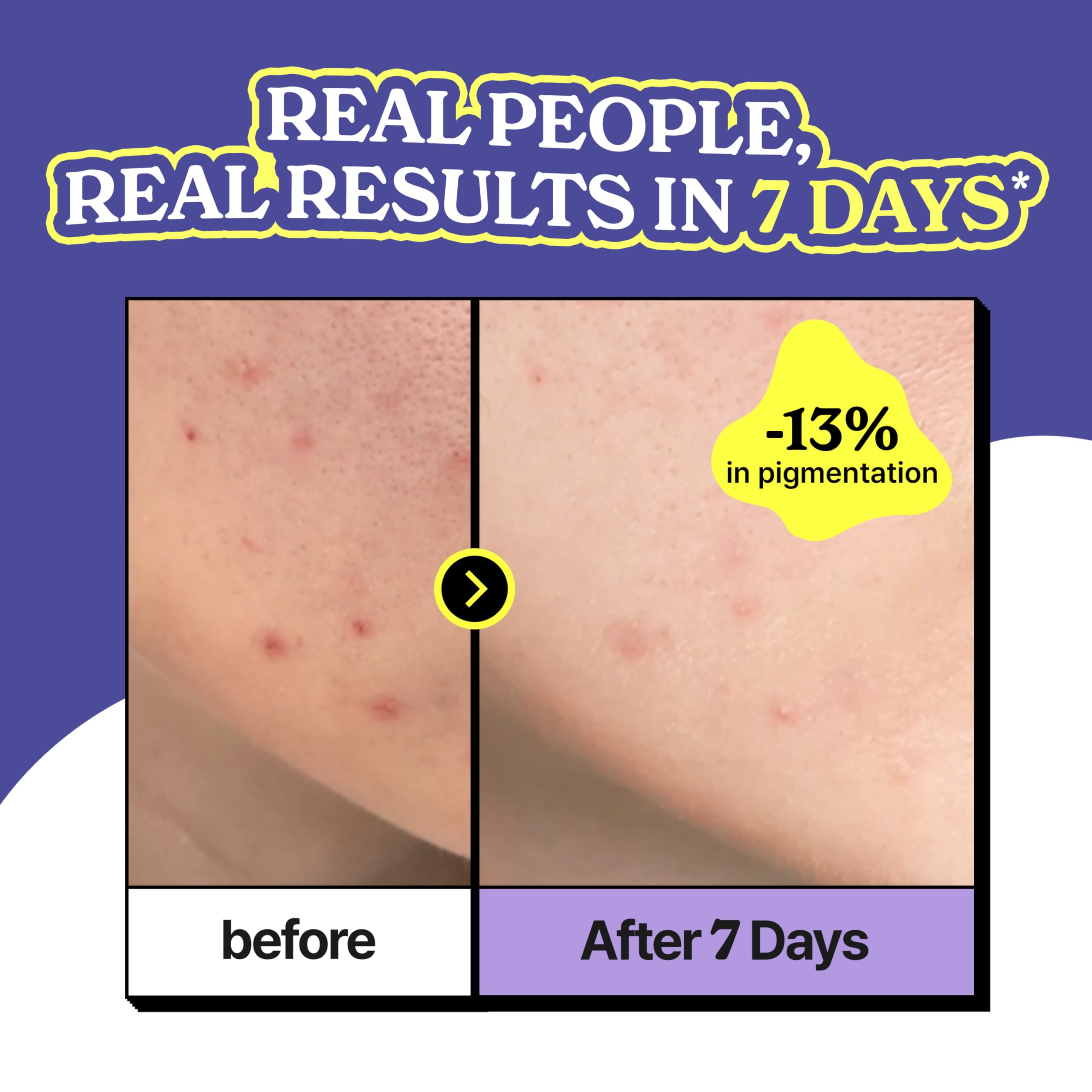 Vividraw Niacin Onion All Clear Ampoule | Acne Dark Spot Serum For Face | Red Onion, 5% Niacinamide, And Vitamin C | Glass Skin,