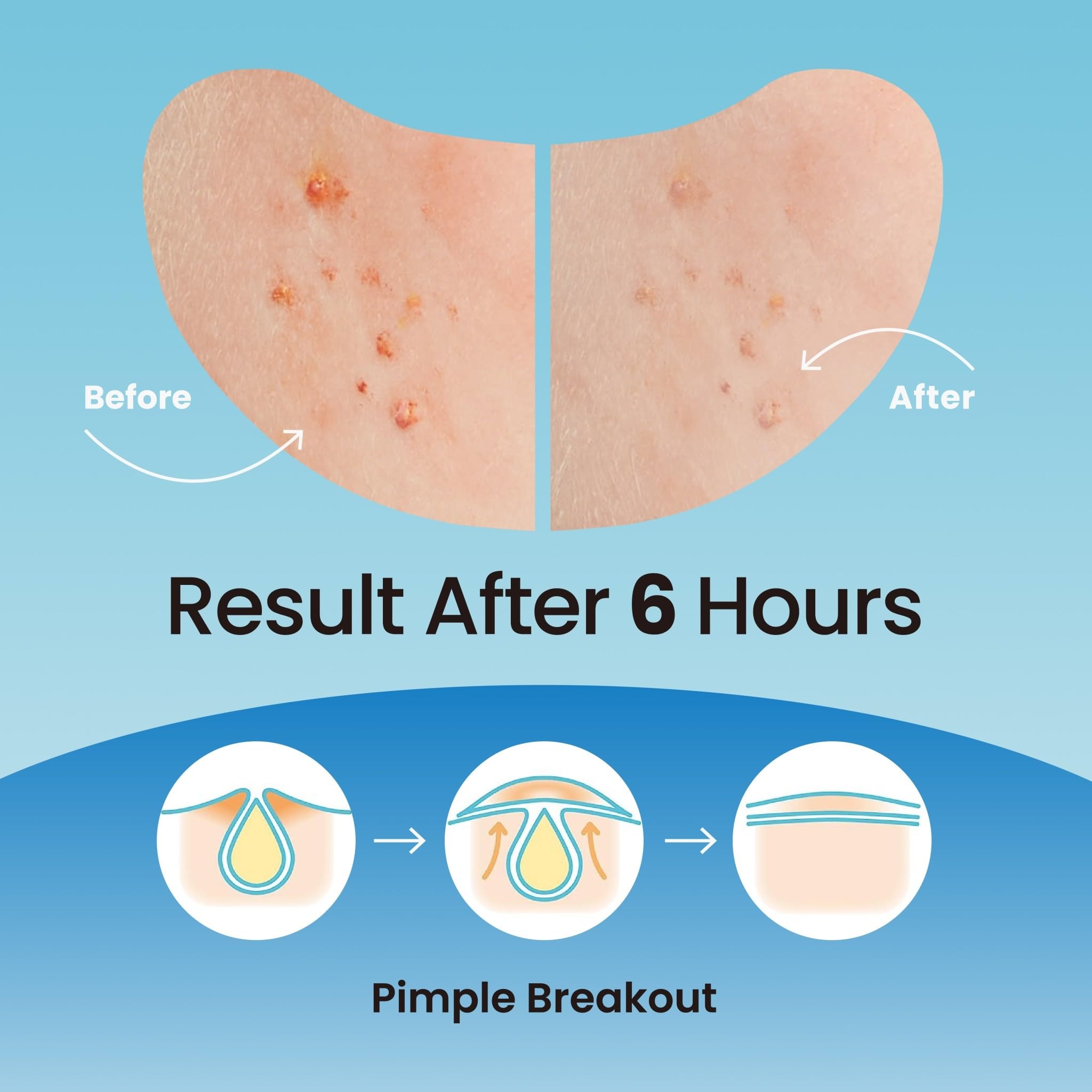 DERMA ANGEL Large Pimple Patches for Nose Chin and Forehead Pores Breakout and Spot Treatment - Acne Patches for Face Hydrocollo