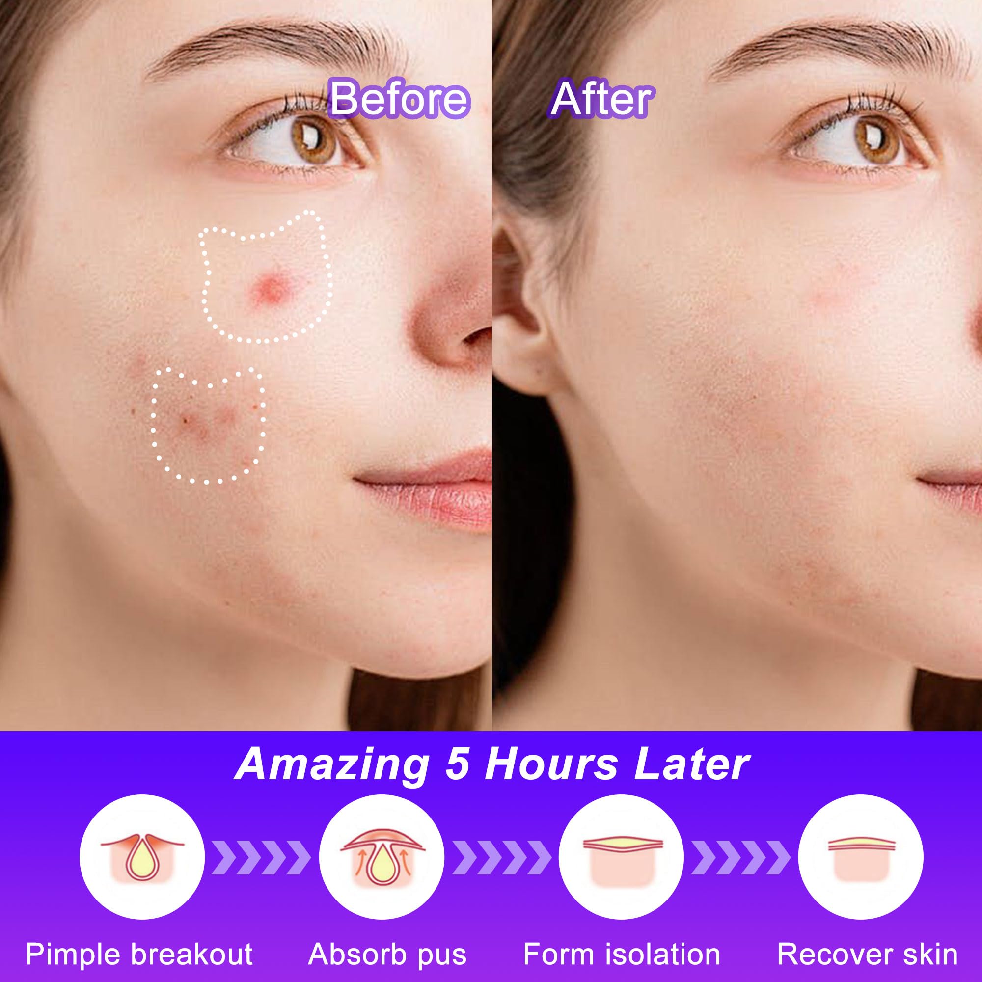 Celecare,Pimple Patches,Acne Patches,Pimple Patches For Face, Cute Stickers,Salicylic Acid & Tea Tree, 120 Hydrocolloid Dots In