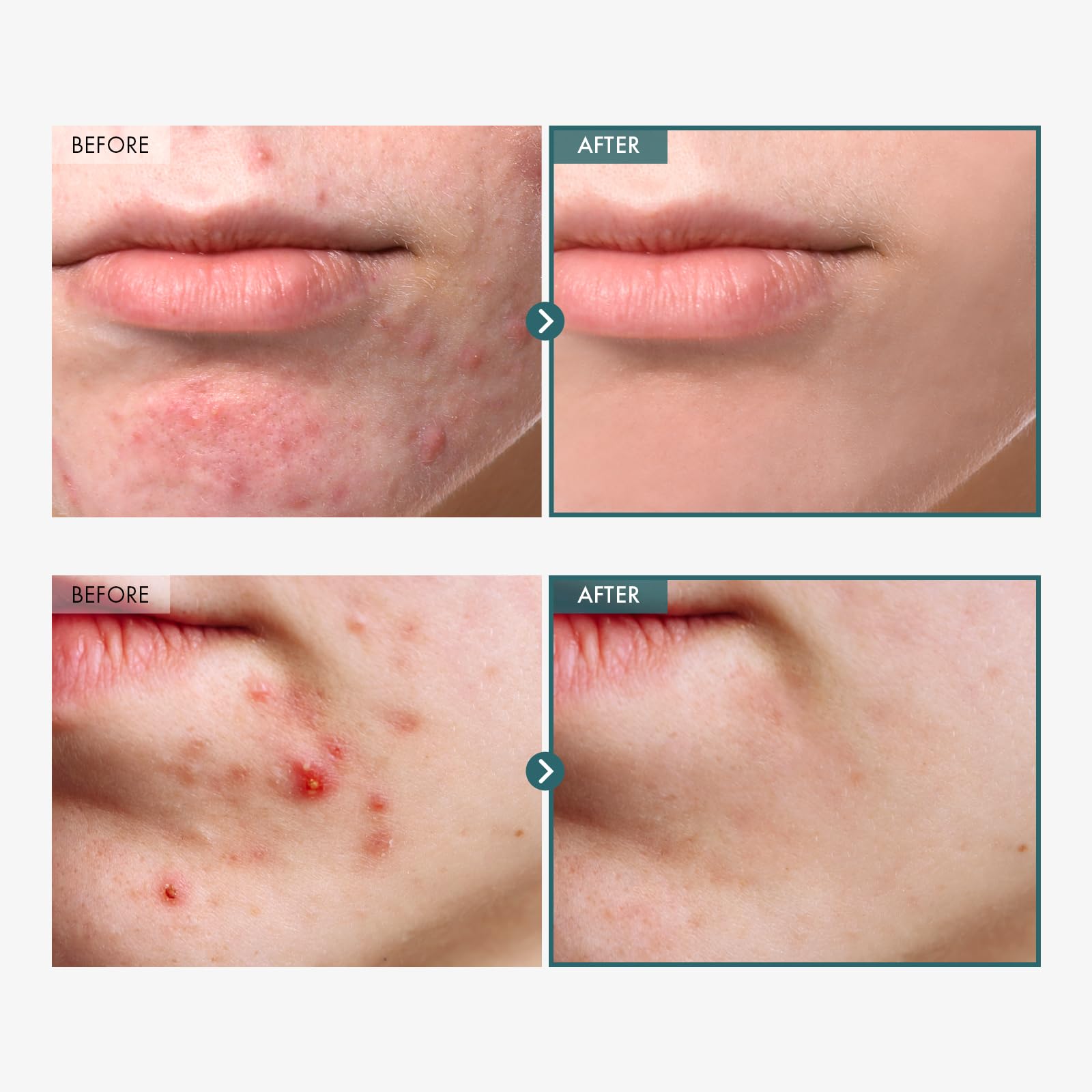TOSOWOONG Adenosine Cica Cream, 520,000ppm Centella Asiatica, Redness Reducing for Oily and Dry Skin Moisturizer, Barrier Cream