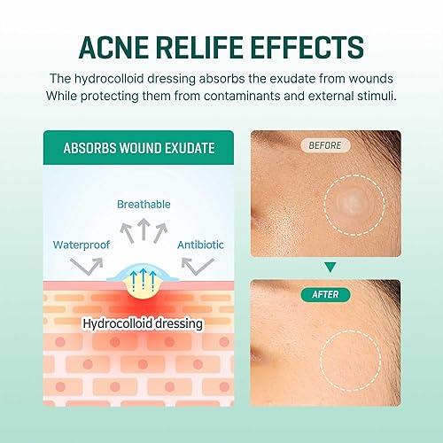 Some By Mi 30 Days Miracle Clear Spot Patch  18Counts, 2 Size (10Mm 9Counts, 12Mm 9Counts)  Invisible Spot Sticker For Sensitive