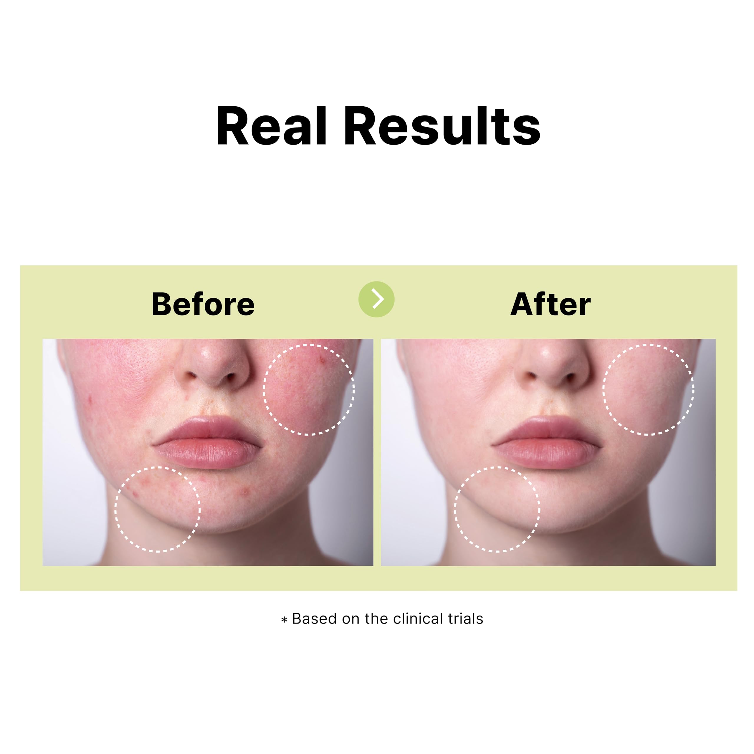 DearMYDEW 10% Azelaic Acid Serum, Niacinamide & Salicylic Acid, 1 Fl Oz - Rosacea Treatment, Cystic Acne Scar & Redness Relief
