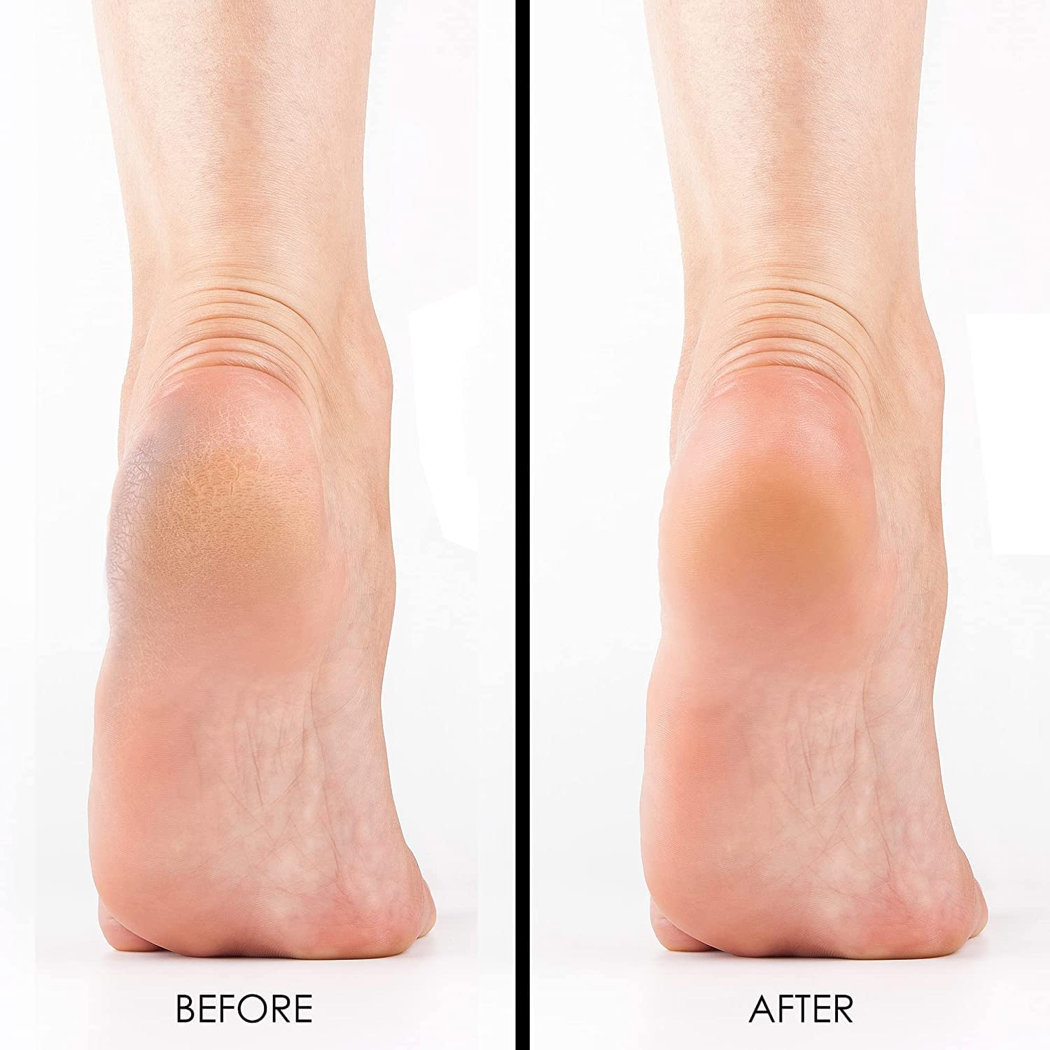 DeEnterprises Callus Remover Gel, Extra Strength, 8oz, Clear - Heavy Duty Foot Care for Rough, Dry, Cracked Skin, Cool Mint
