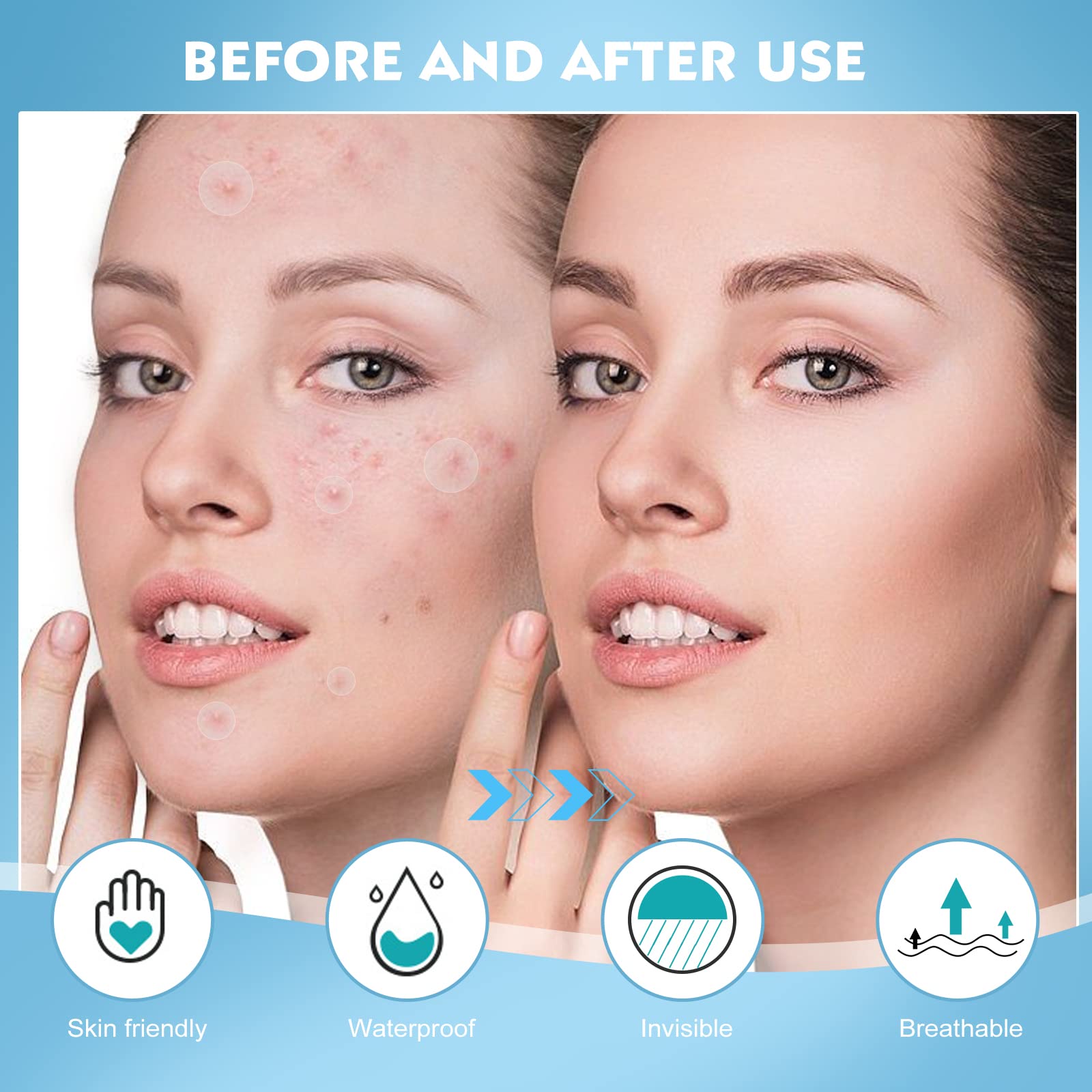 Soonuly Pimple Patches for Face - 180 Hydrocolloid Acne Pimple Patches Salicylic Acid with Tea Tree Oil for Zit Blemish Spot Cov
