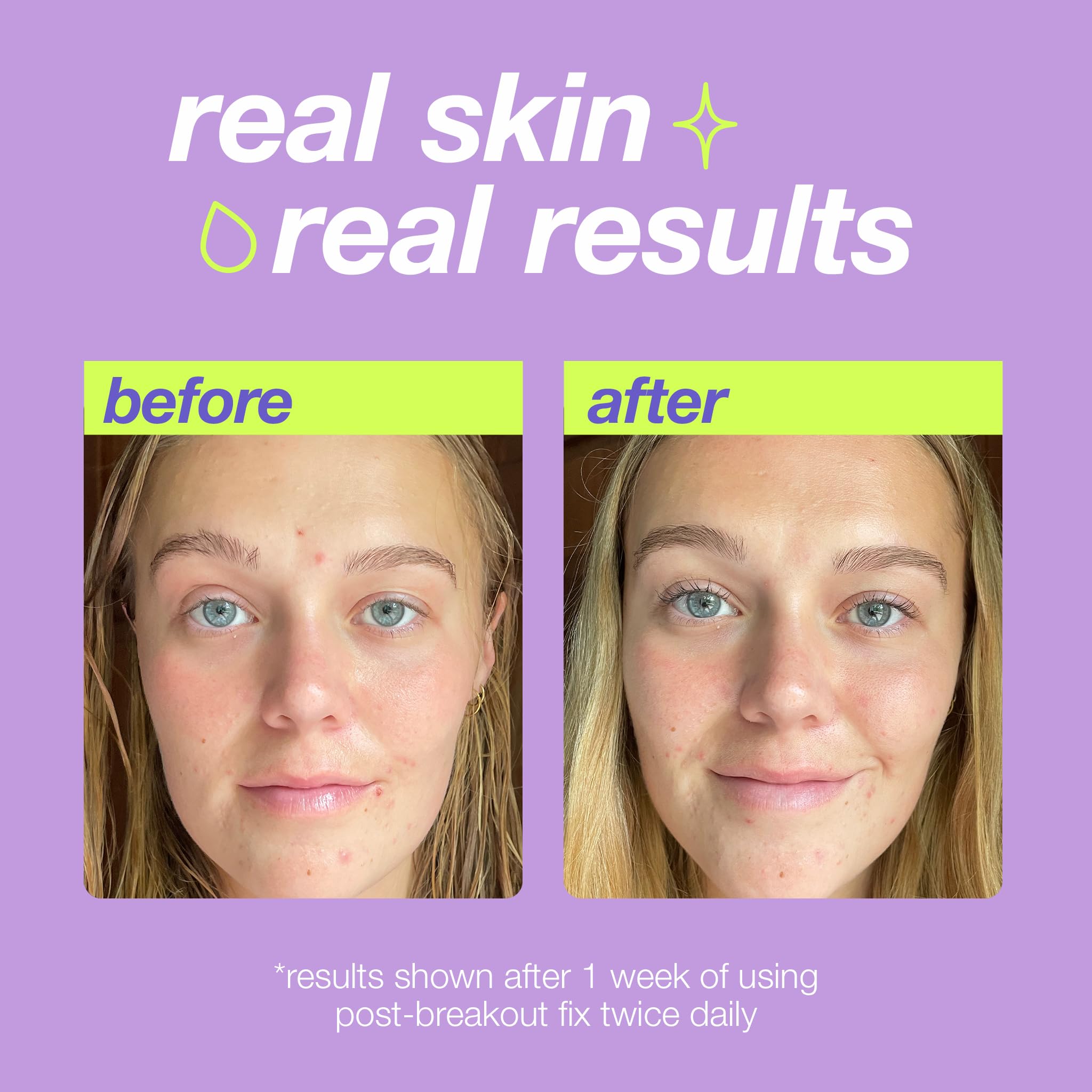 Dermalogica Clear Start Post-Breakout Fix, Acne Dark Spot Treatment with Salicylic Acid, Squalene & Hexylresorcinol, Fade + Brig