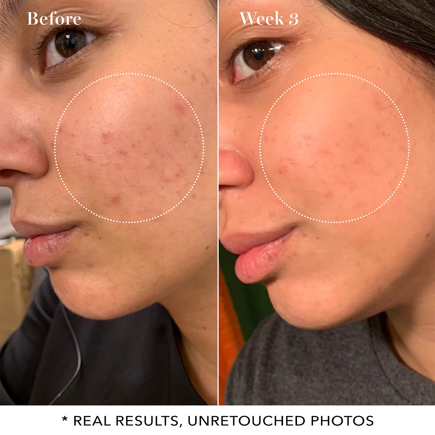 Saturday Skin Pore Clarifying Toner 10% Glycolic Acid&AHA Deep Cleansing Astringent Facial Toner,Hypoallergenic Skin-Purifying F