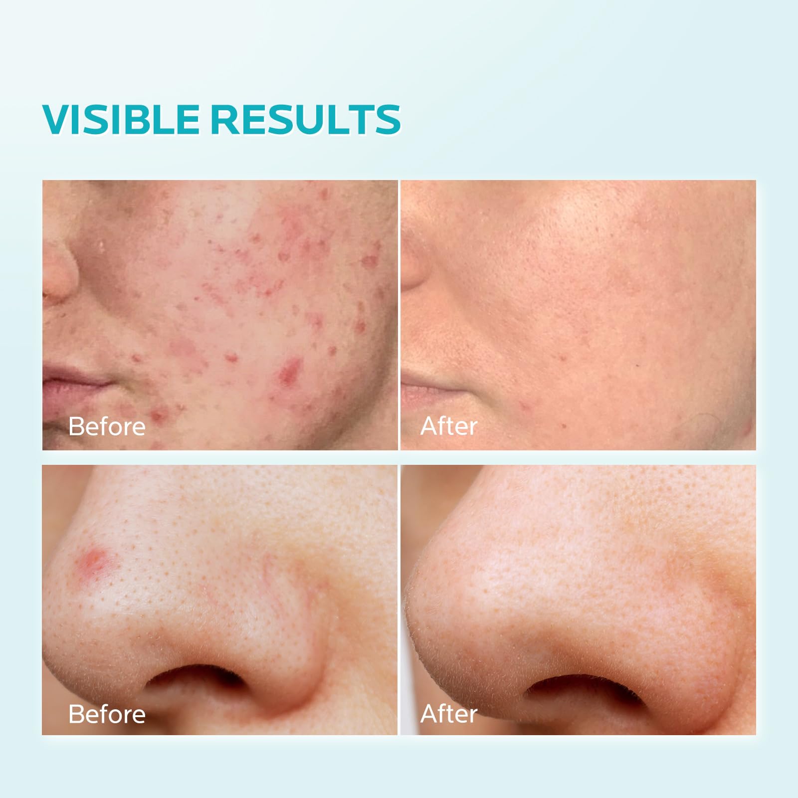 Zealsea Azelaic Acid 10% Facial Cream For Redness Relief Face Skin Care, Pimple Pigmentation Blackhead, Balance Excess Sebum, Cl