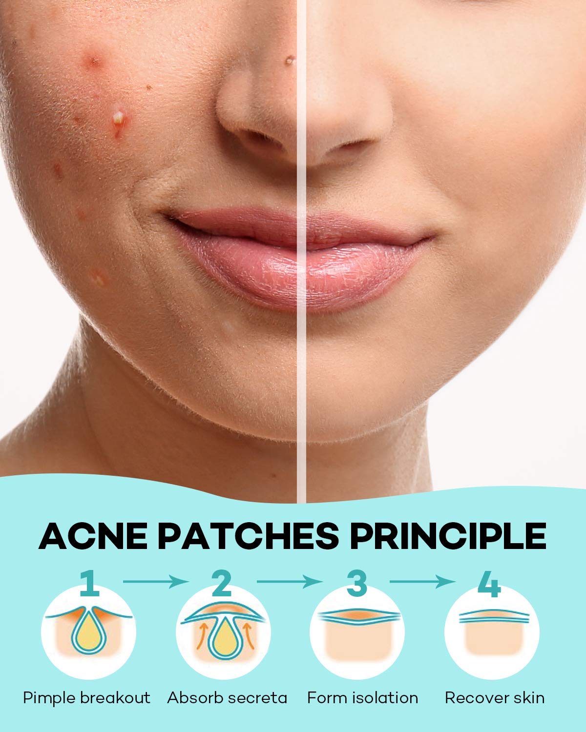Acne Patch Pimple Patch, 4 Sizes 280 Patches Acne Absorbing Cover Patch, Hydrocolloid Invisible Acne Patches For Face Zit Patch