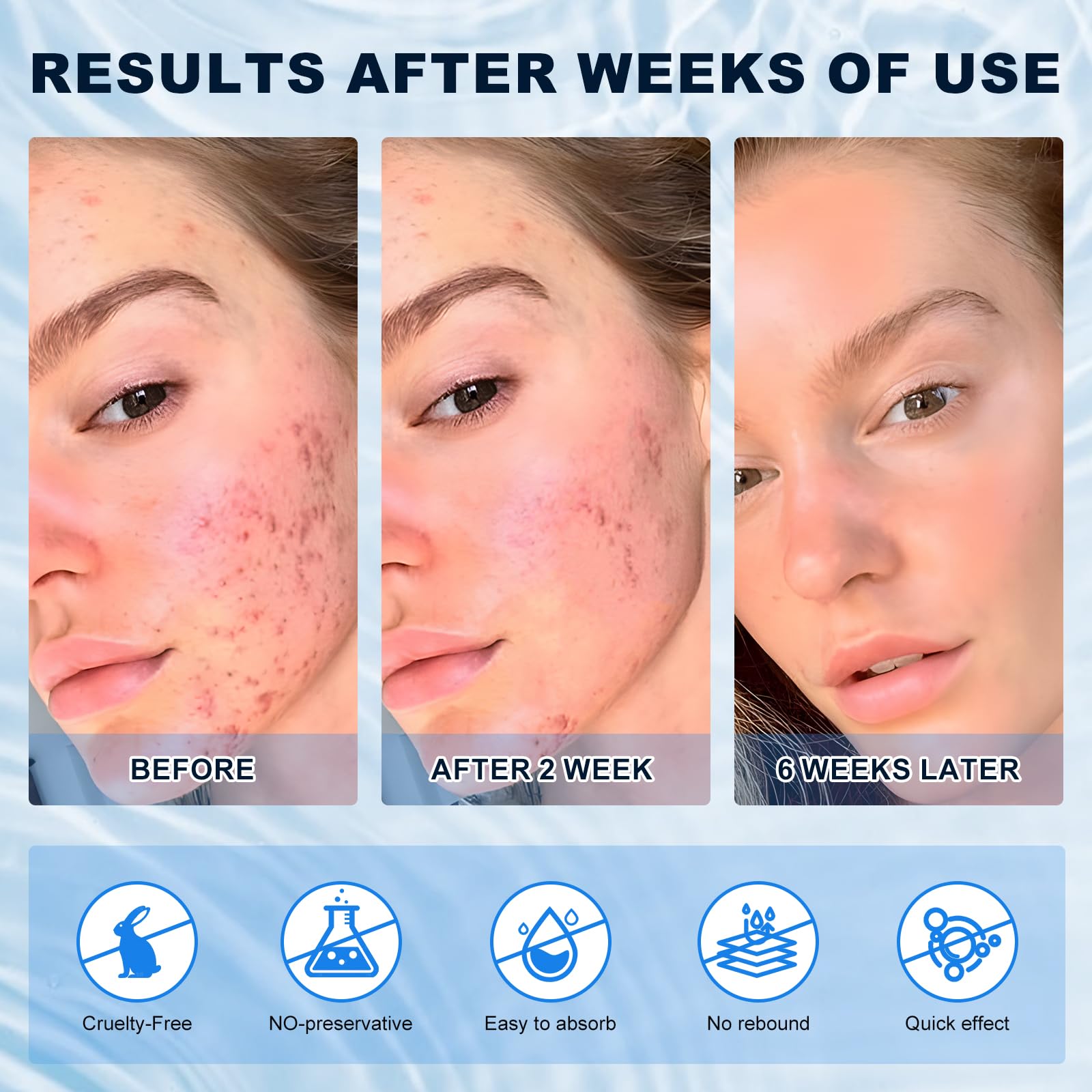 Azelaic Acid 10% Cream for Face - Acne Cream for Rosacea Reducing Relief Pimple Breakouts Blackhead Pigmentation and Redness - A