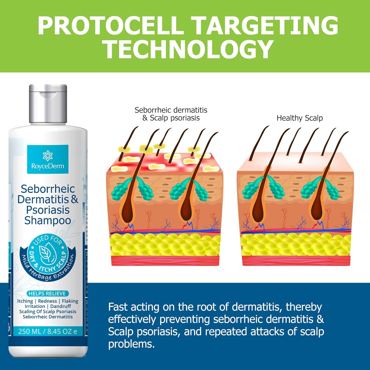 Roycederm Psoriasis Shampoo, Seborrheic Dermatitis Shampoo, Folliculitis Shampoo, Dandruff Shampoo, Scalp Psoriasis & Seborrheic