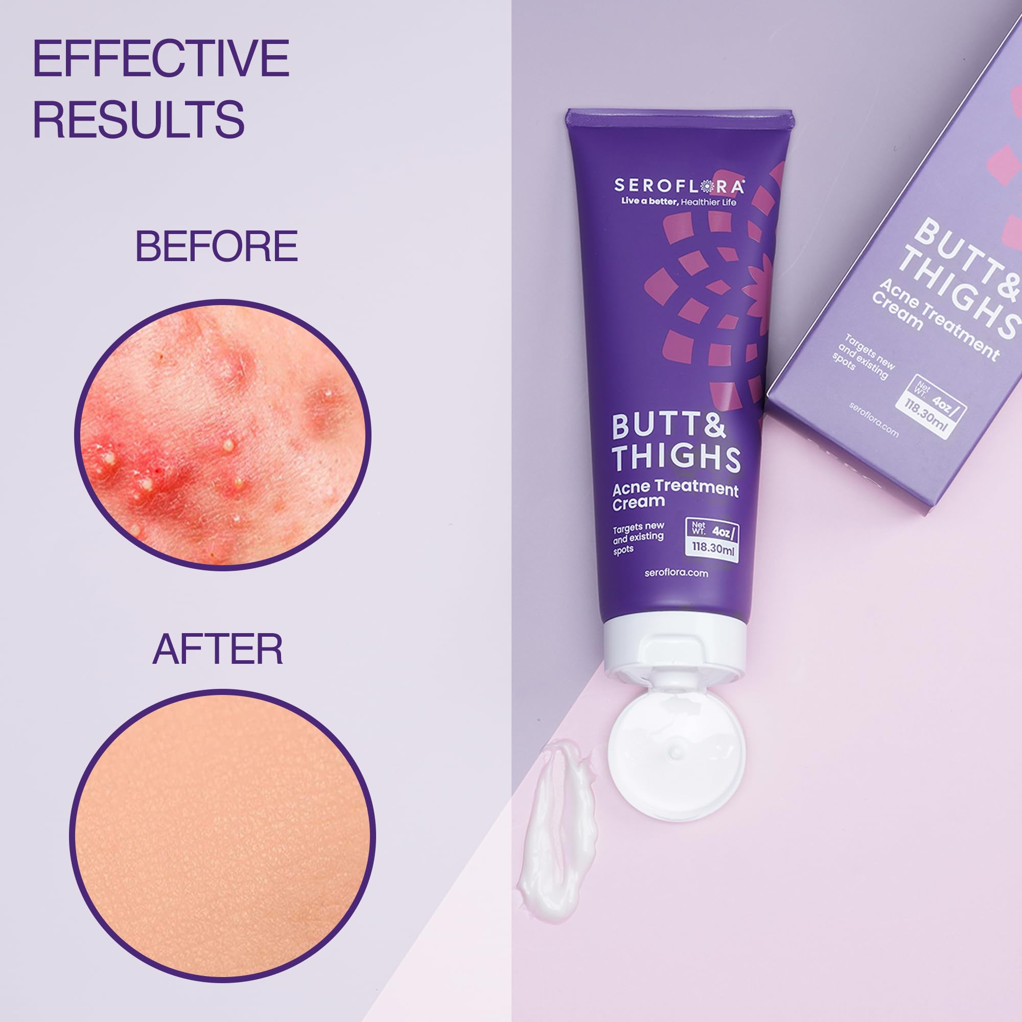 Seroflora Butt & Thighs Acne Treatment Cream - Butt Acne Clearing Cream for Pimples, Zits, Razor Bumps, Dark Spots - Acne Cleari