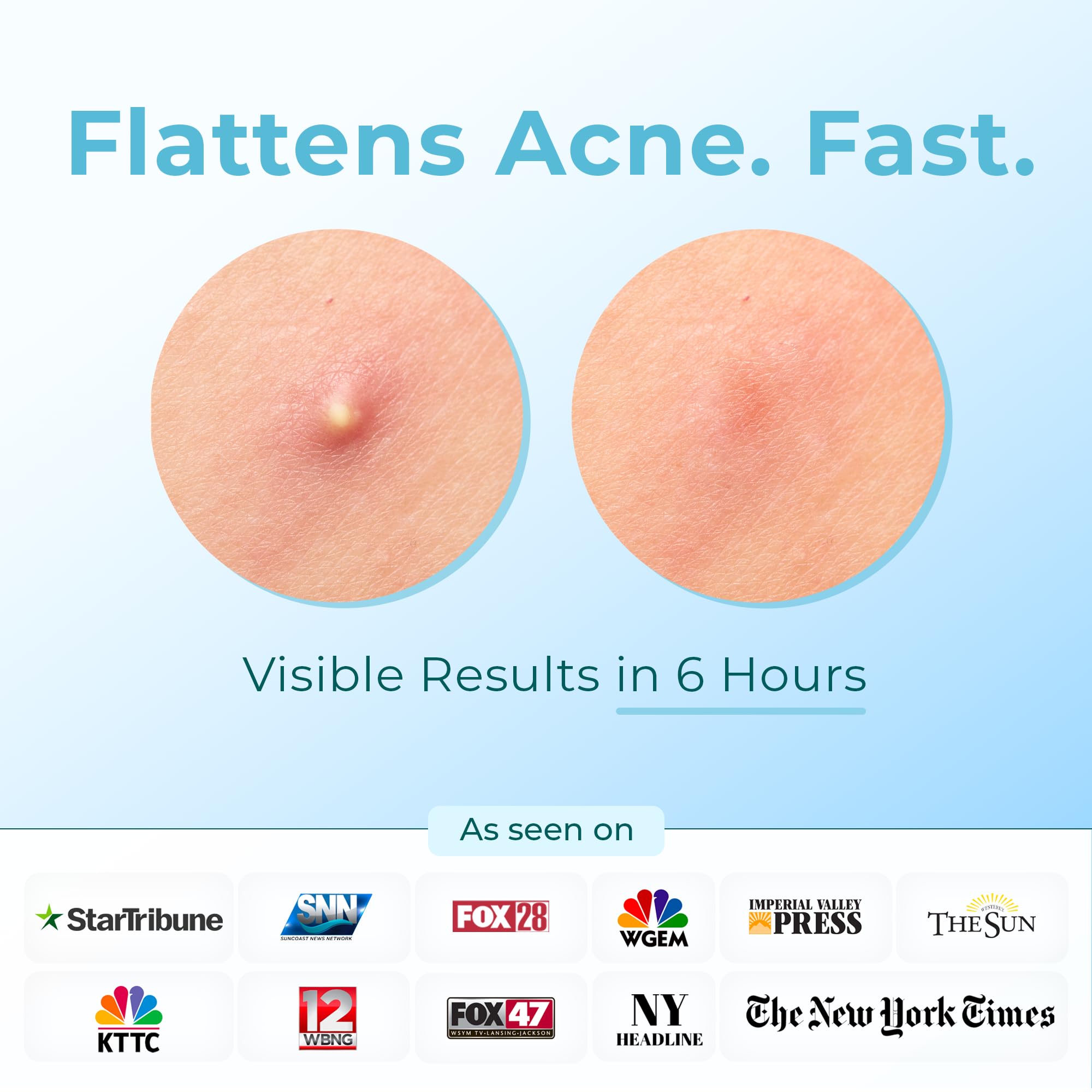 Pimple Patches (Made In Korea) For Face & Body - Overnight Treatment - Acne Patch For Zits, Bumps, Spots, Pimples, Whiteheads -
